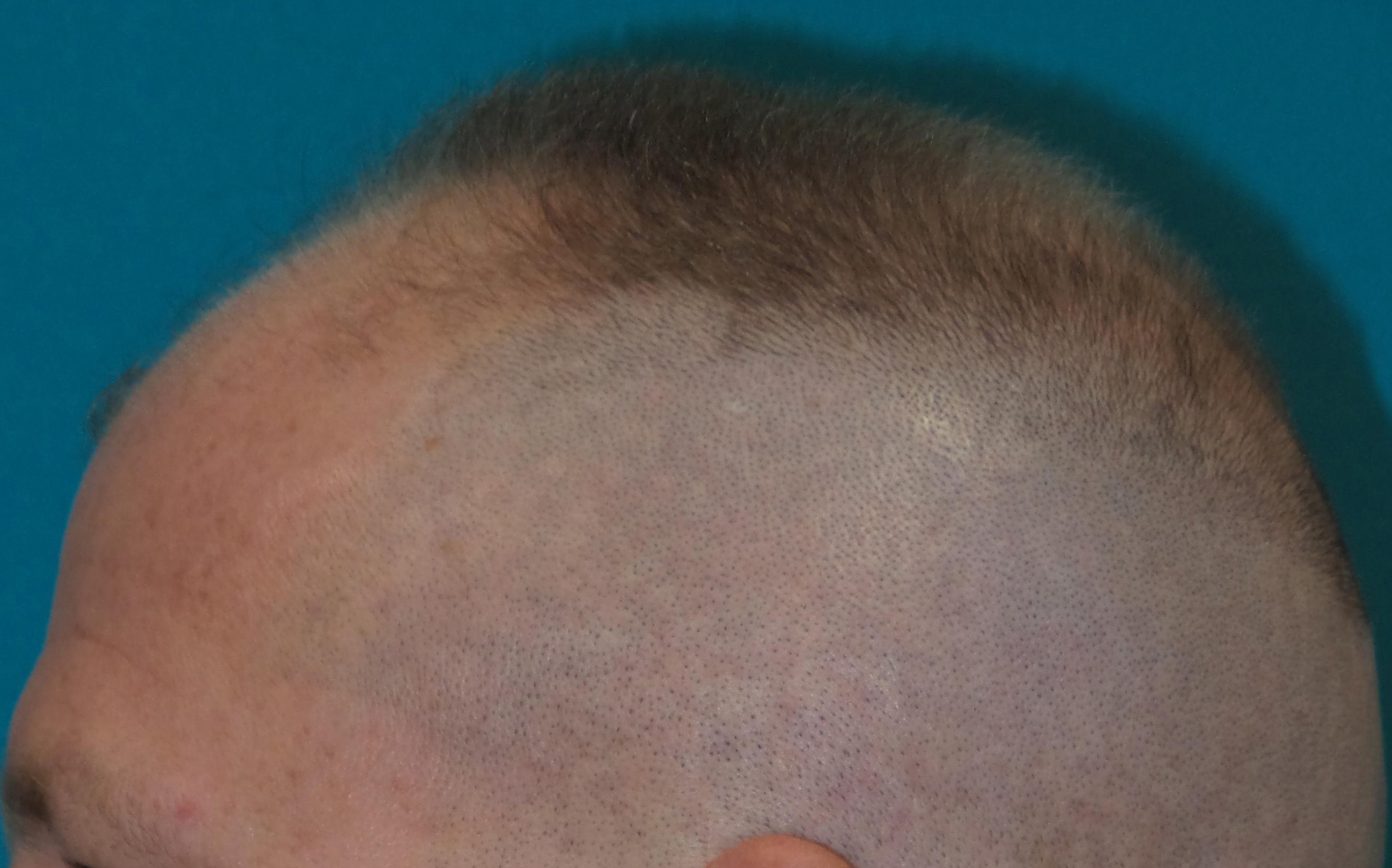 Hair Transplant Before and After | Princeton Plastic Surgeons