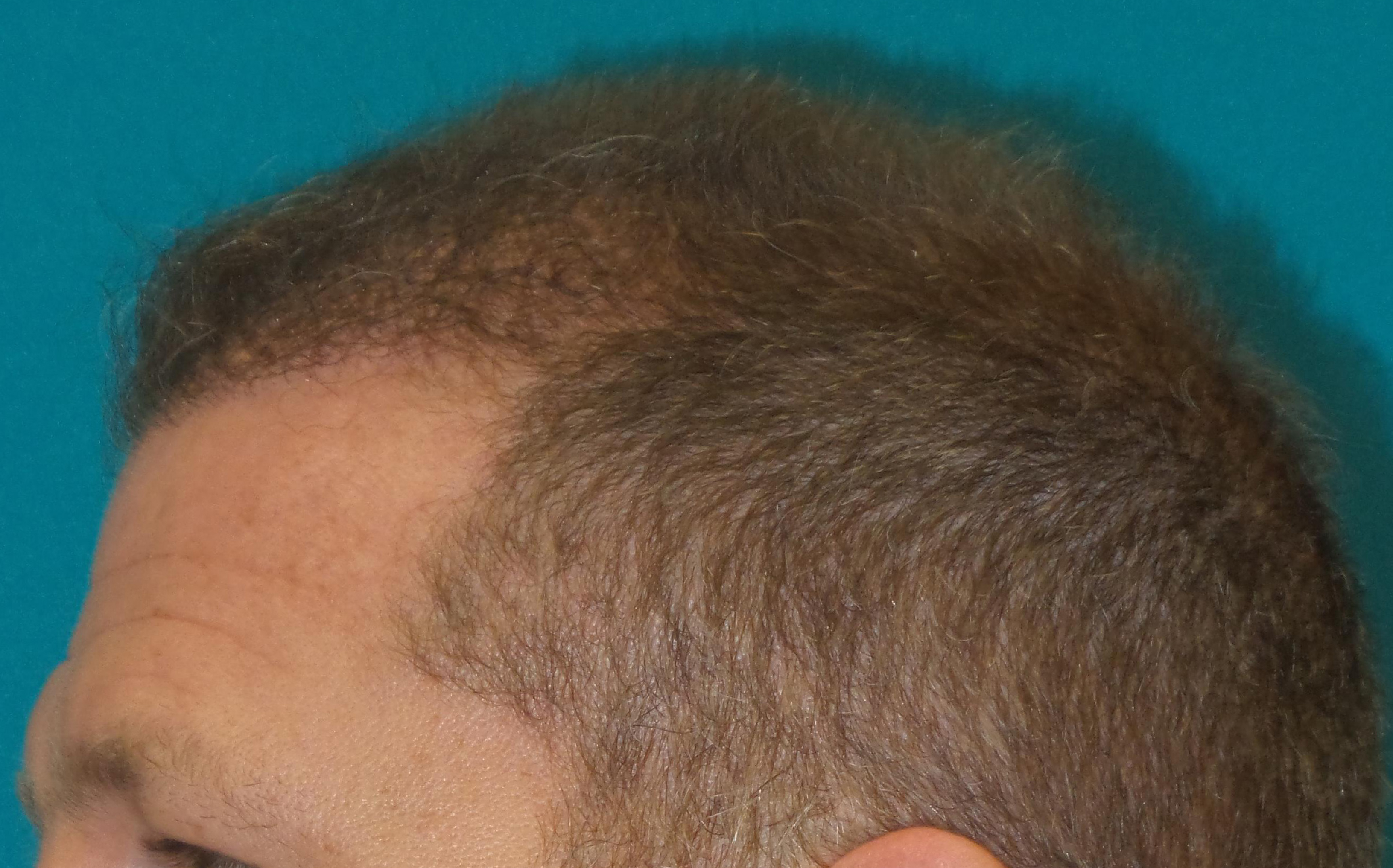 Hair Transplant Before and After | Princeton Plastic Surgeons