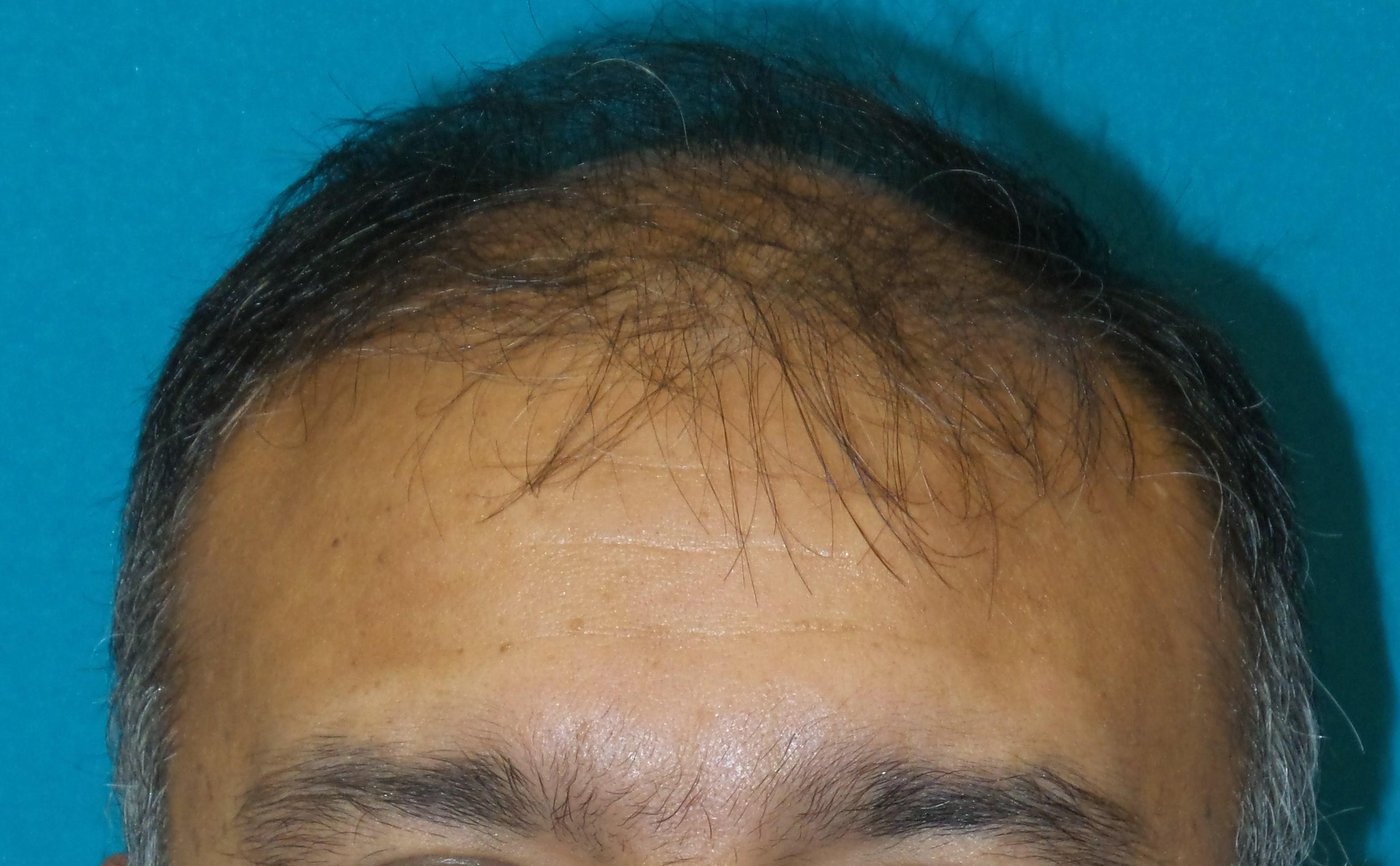 Hair Transplant Before and After | Princeton Plastic Surgeons