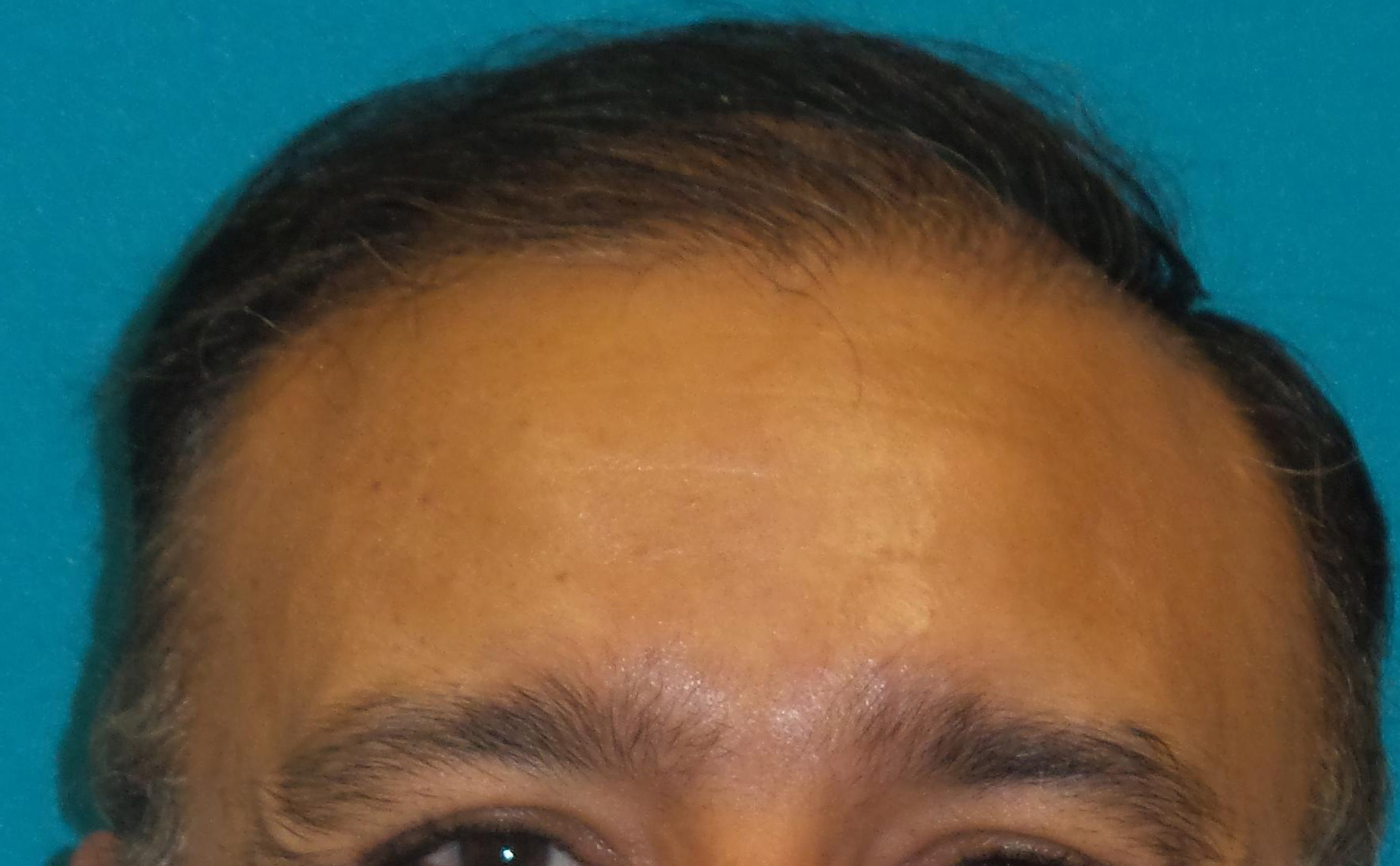 Hair Transplant Before and After | Princeton Plastic Surgeons