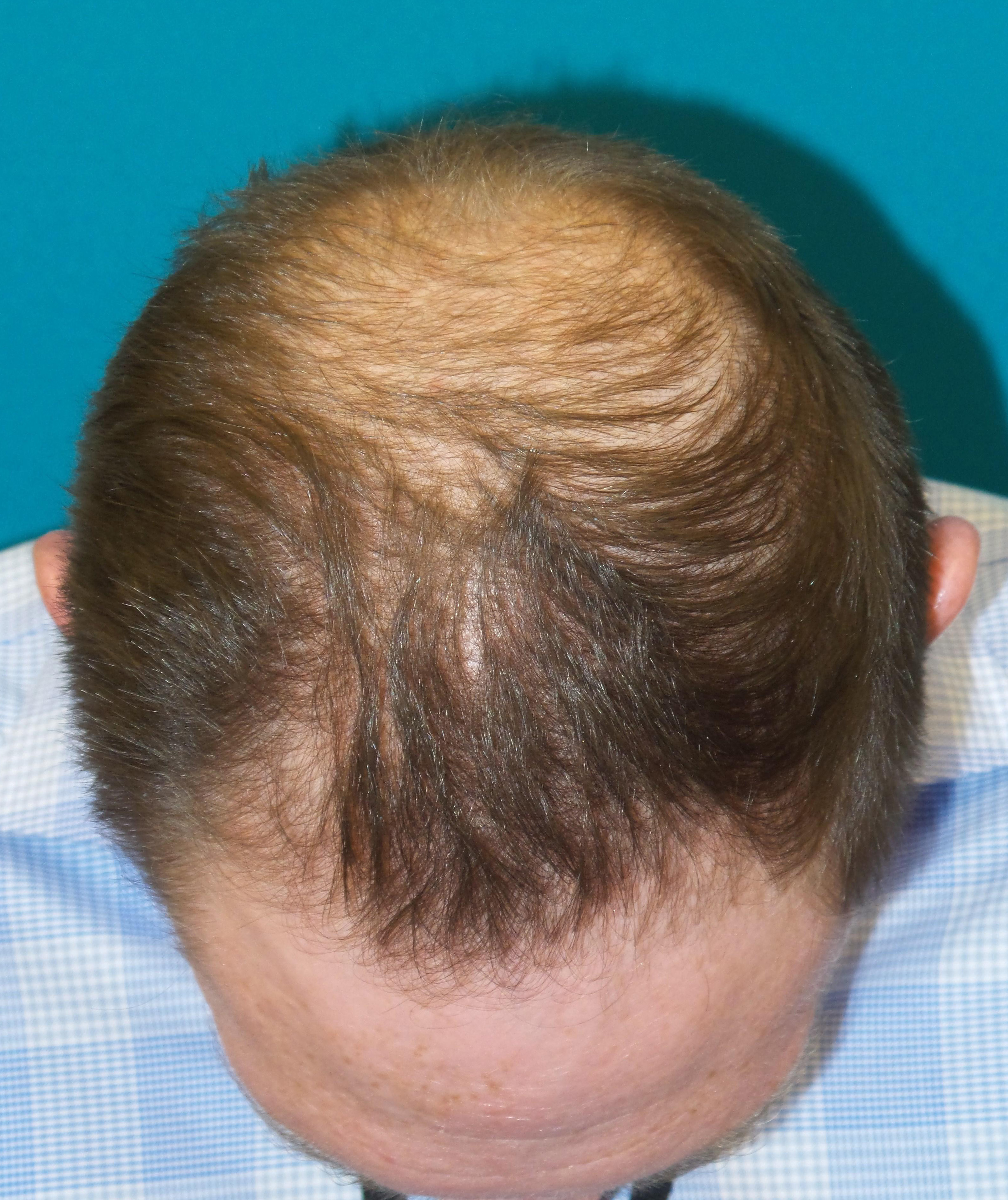 Hair Transplant Before and After | Princeton Plastic Surgeons