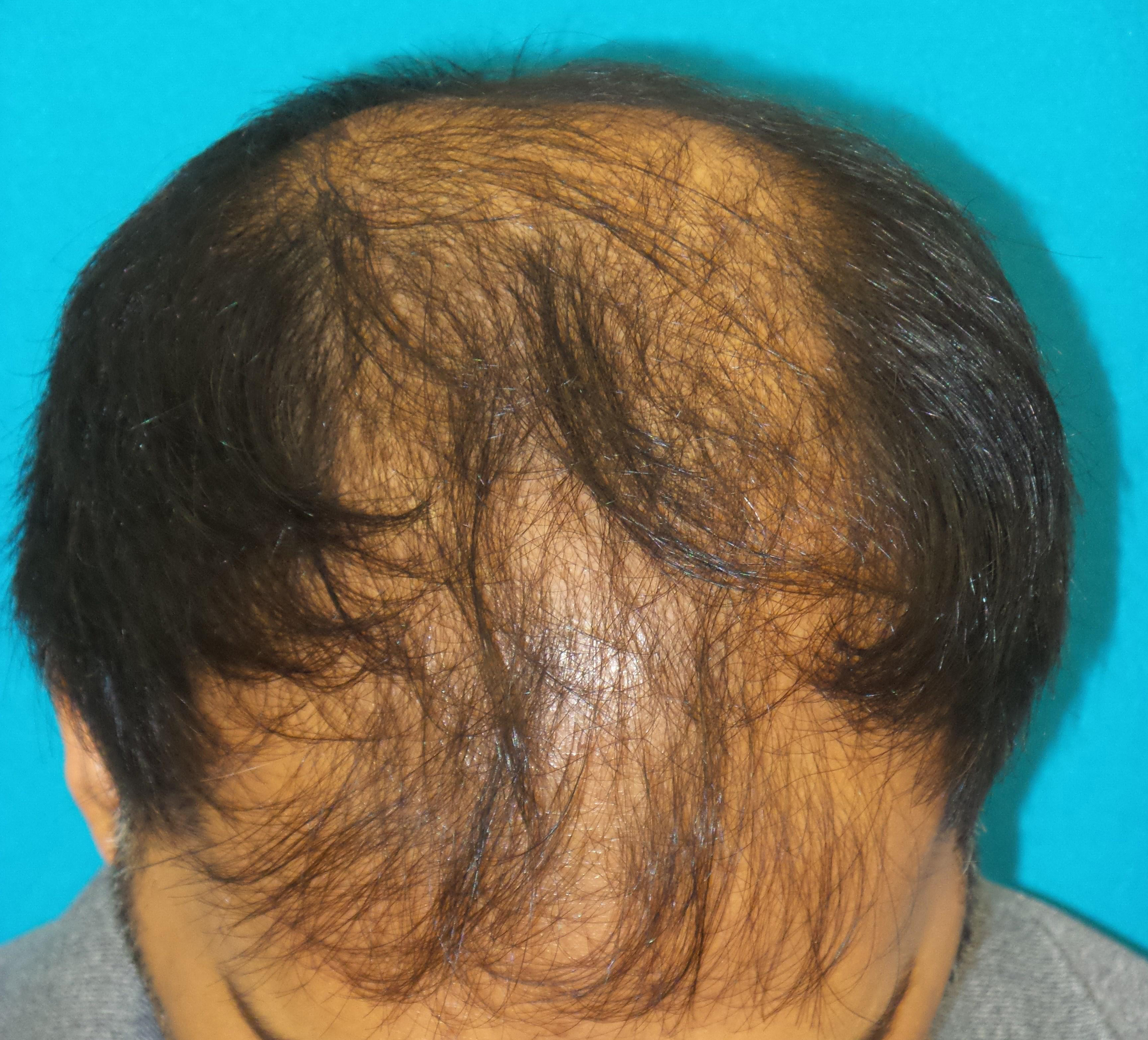 Hair Transplant Before and After | Princeton Plastic Surgeons