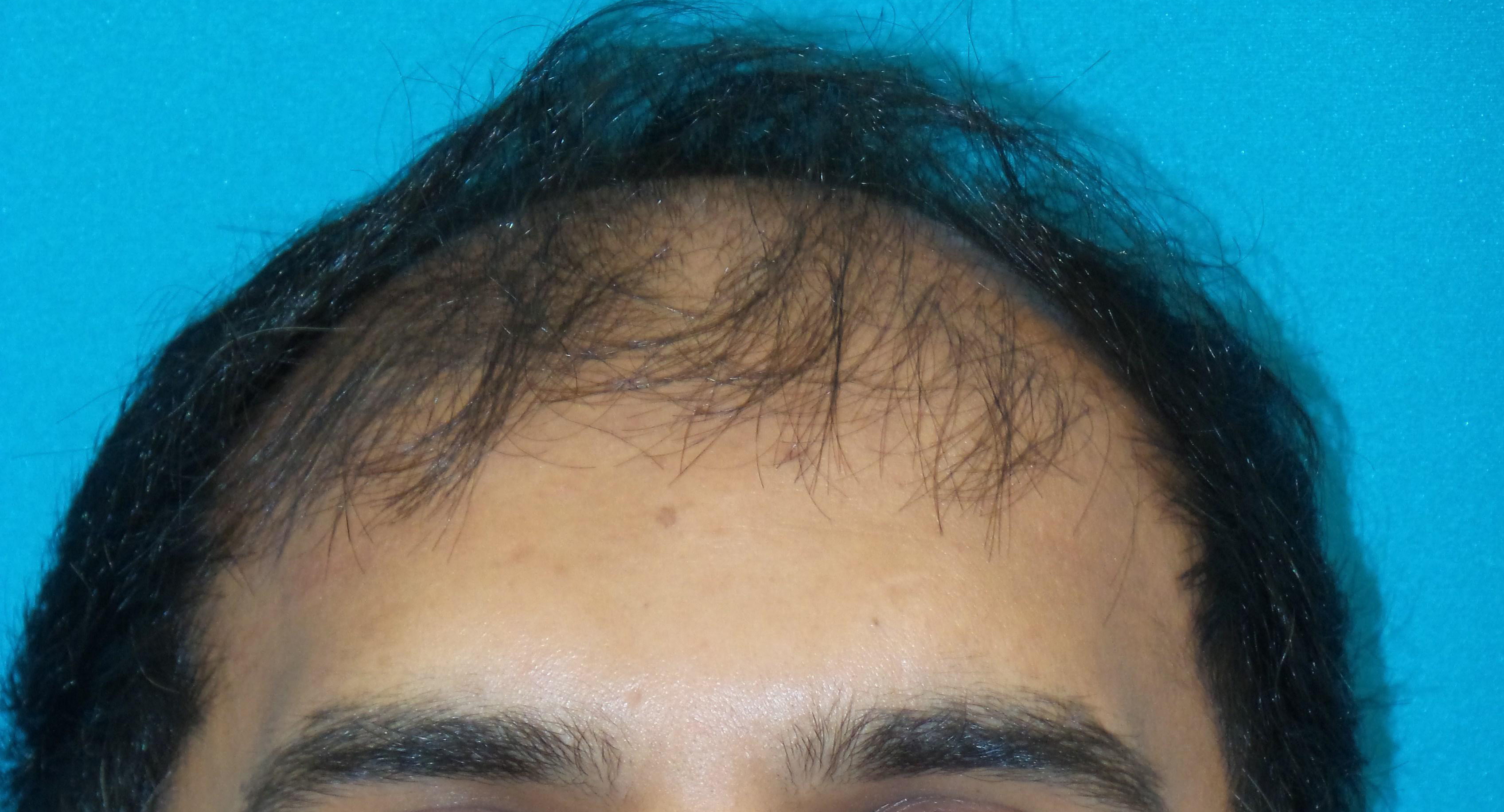 Hair Transplant Before and After | Princeton Plastic Surgeons