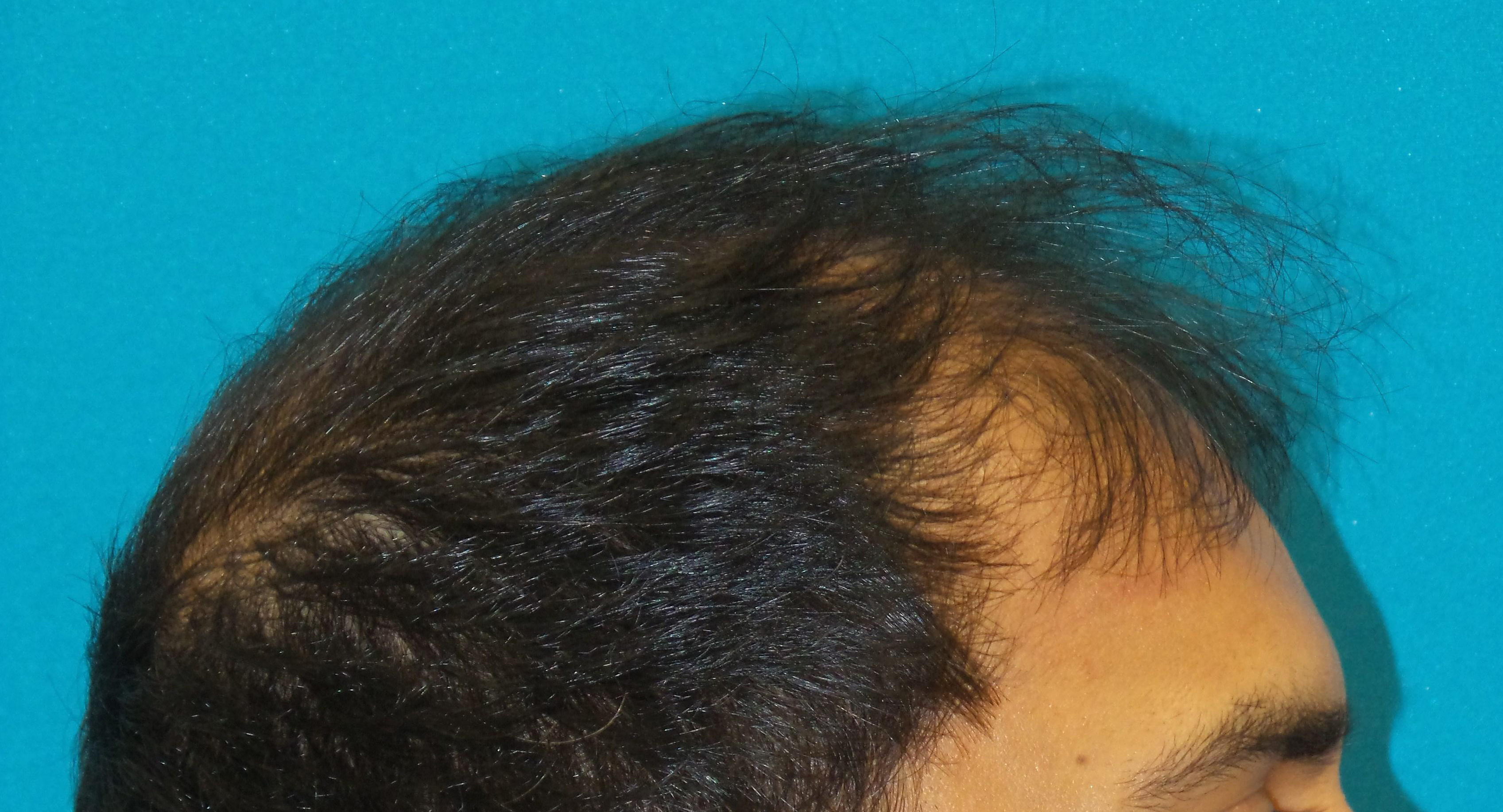 Hair Transplant Before and After | Princeton Plastic Surgeons