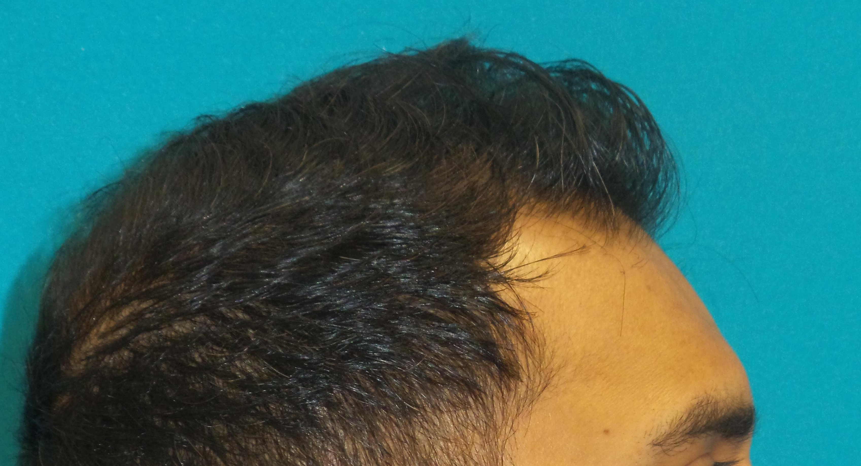 Hair Transplant Before and After | Princeton Plastic Surgeons