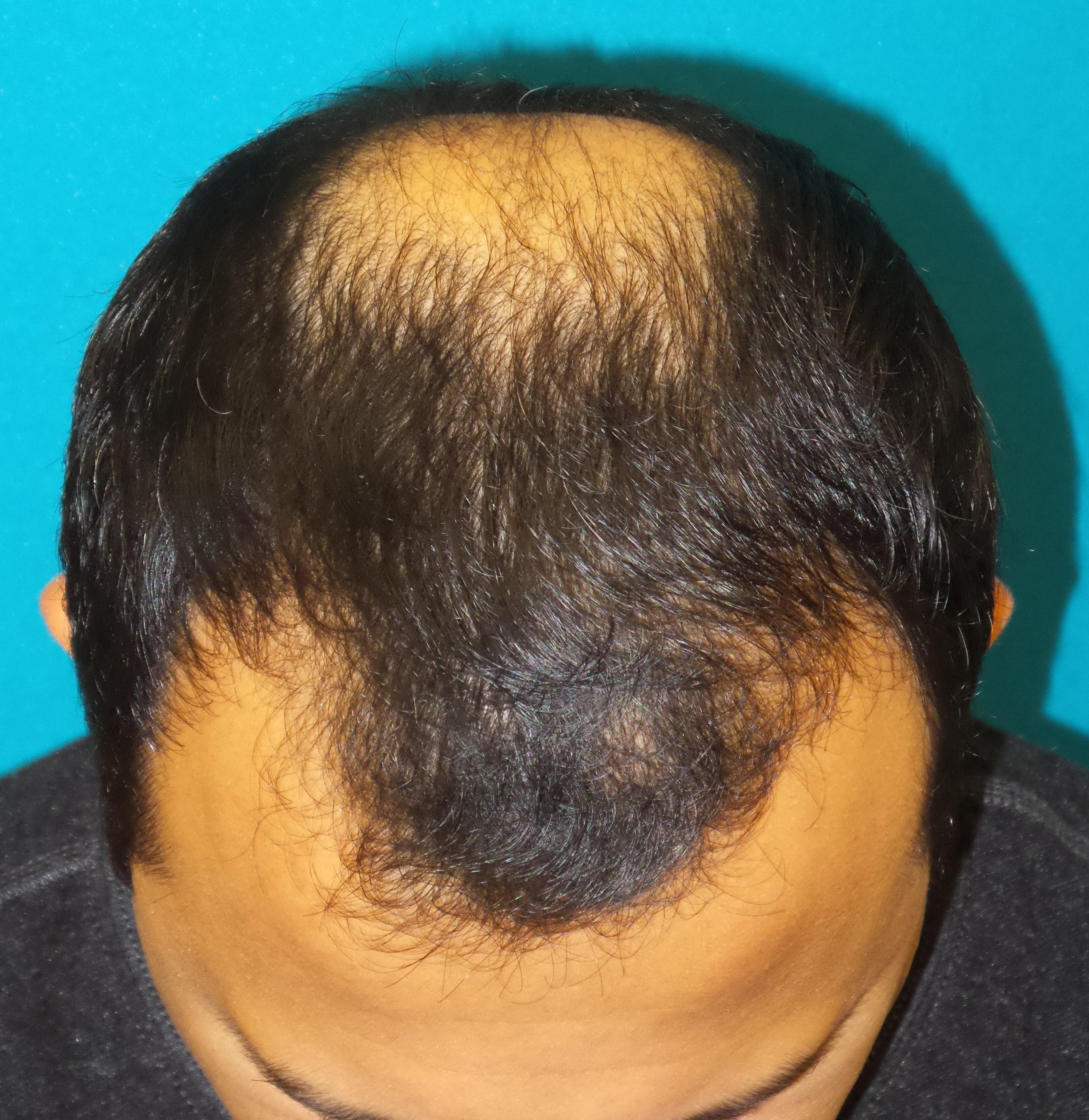 Hair Transplant Before and After | Princeton Plastic Surgeons