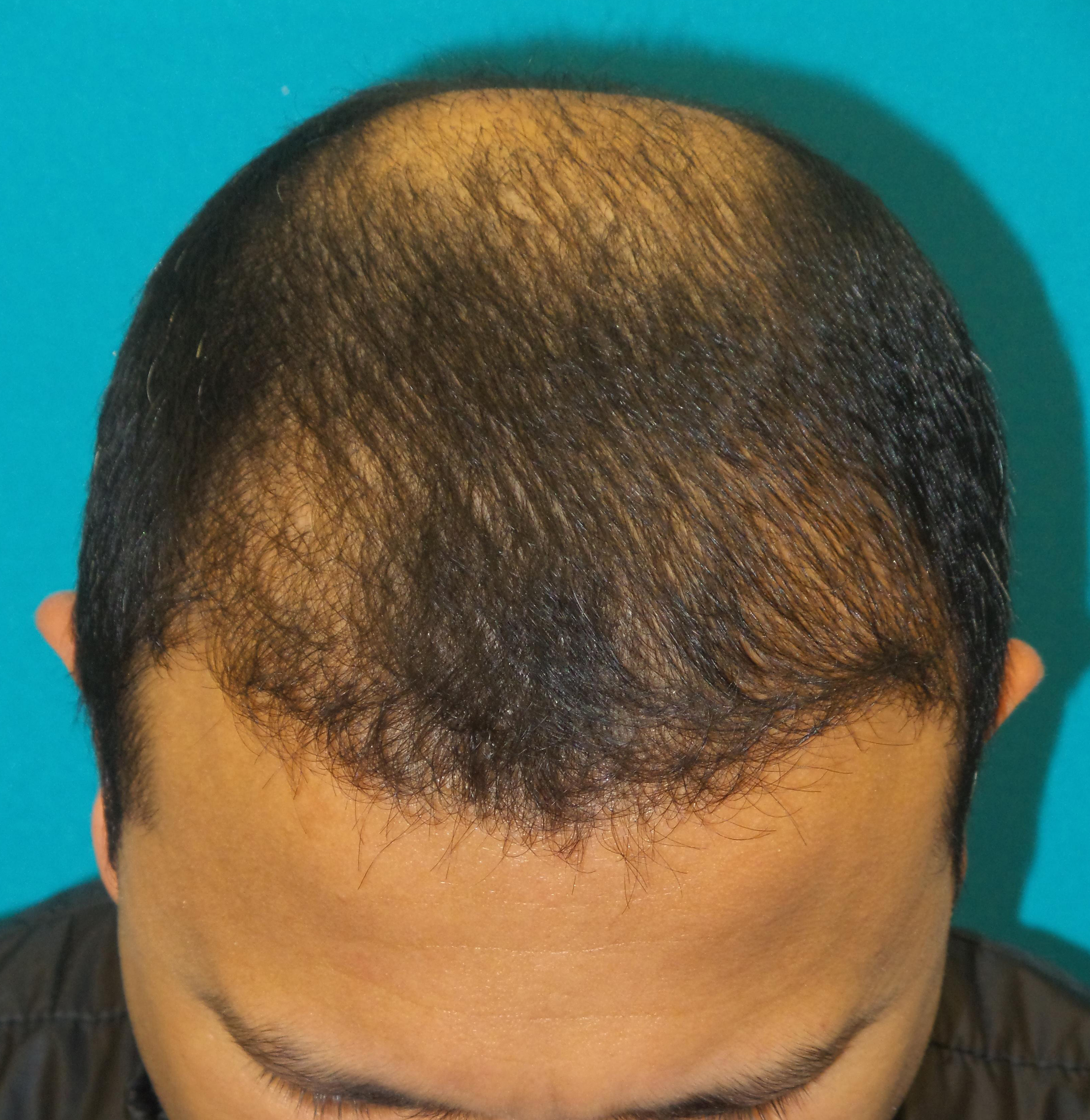 Hair Transplant Before and After | Princeton Plastic Surgeons