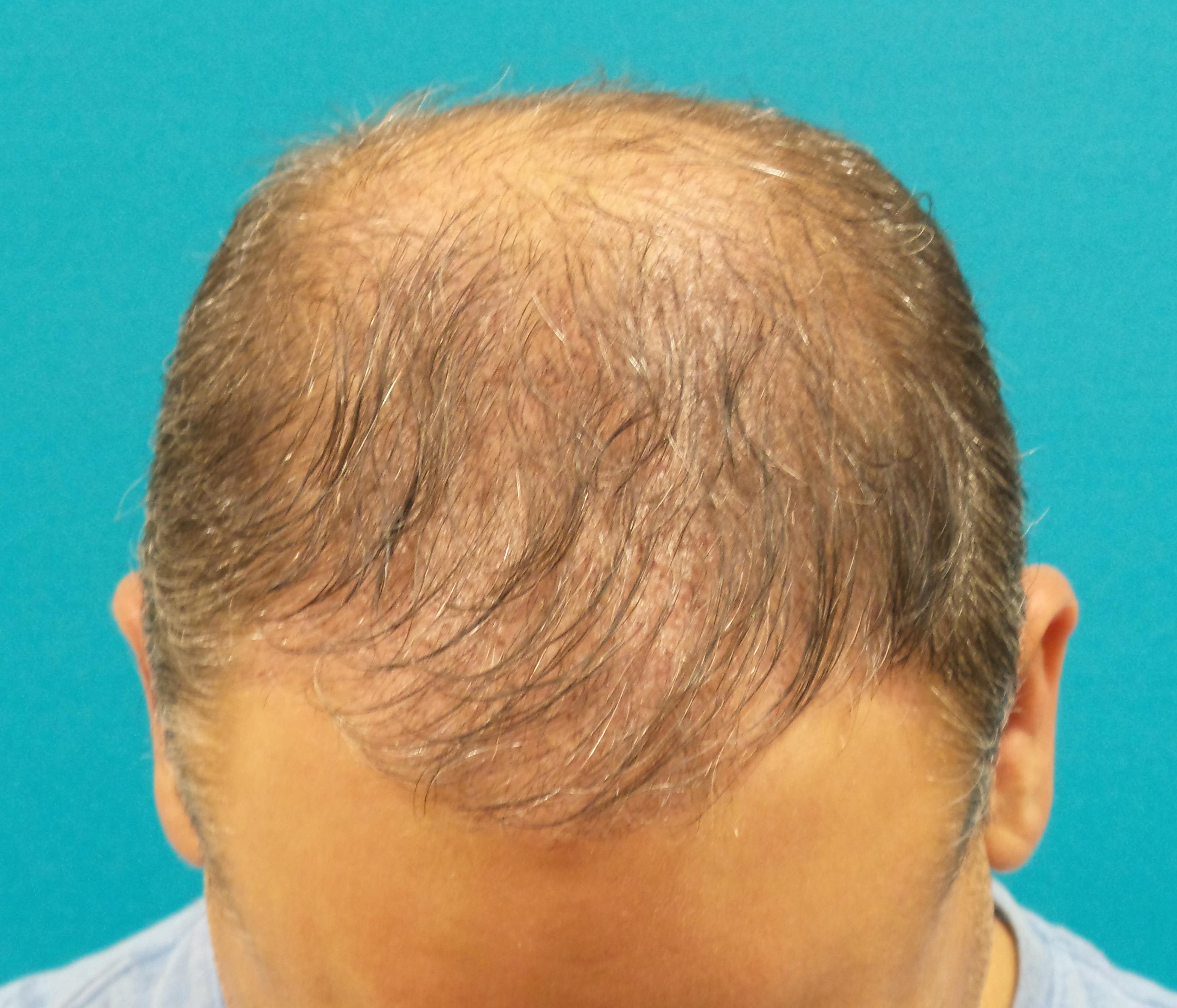 Hair Transplant Before and After | Princeton Plastic Surgeons