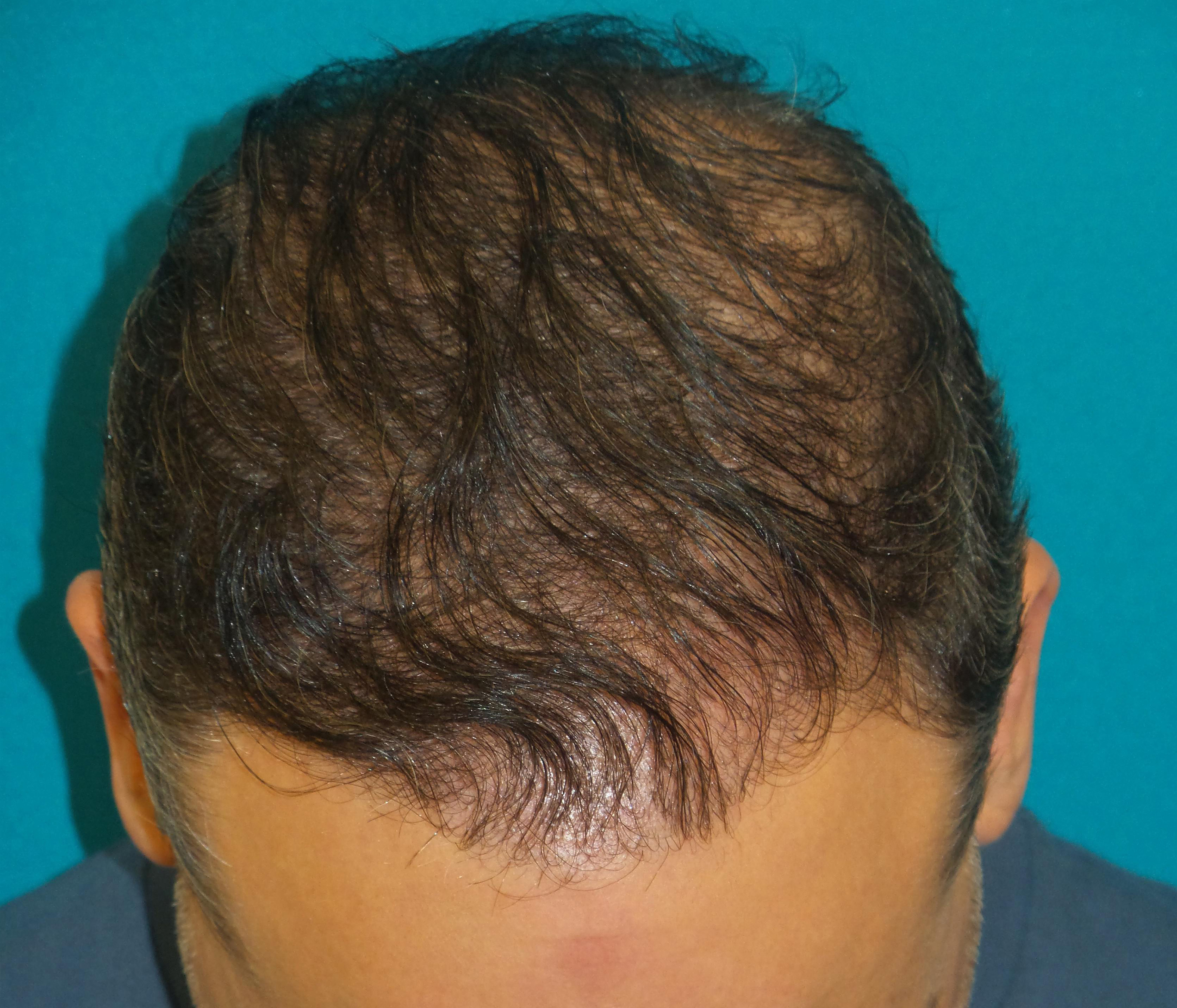 Hair Transplant Before and After | Princeton Plastic Surgeons