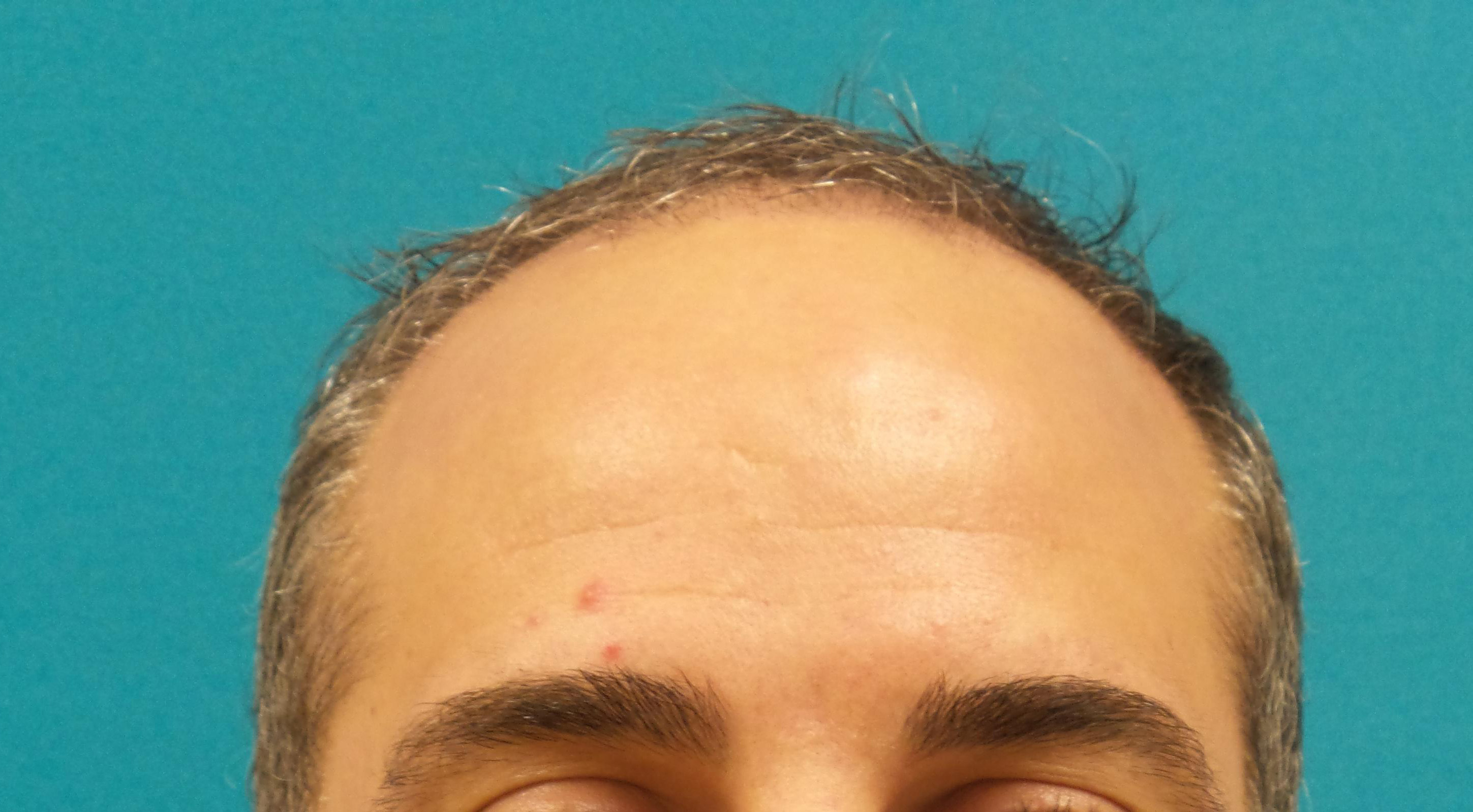 Hair Transplant Before and After | Princeton Plastic Surgeons