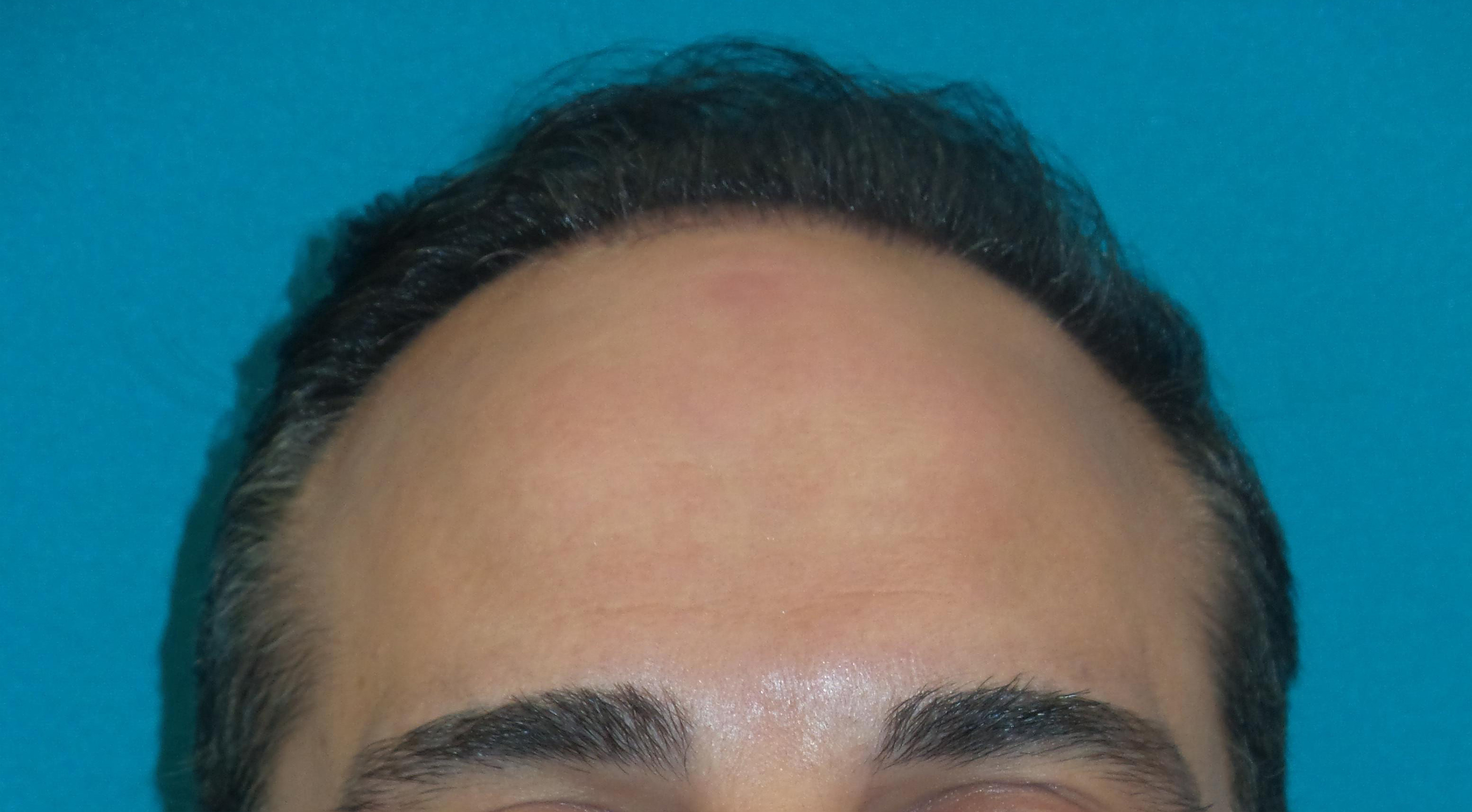 Hair Transplant Before and After | Princeton Plastic Surgeons