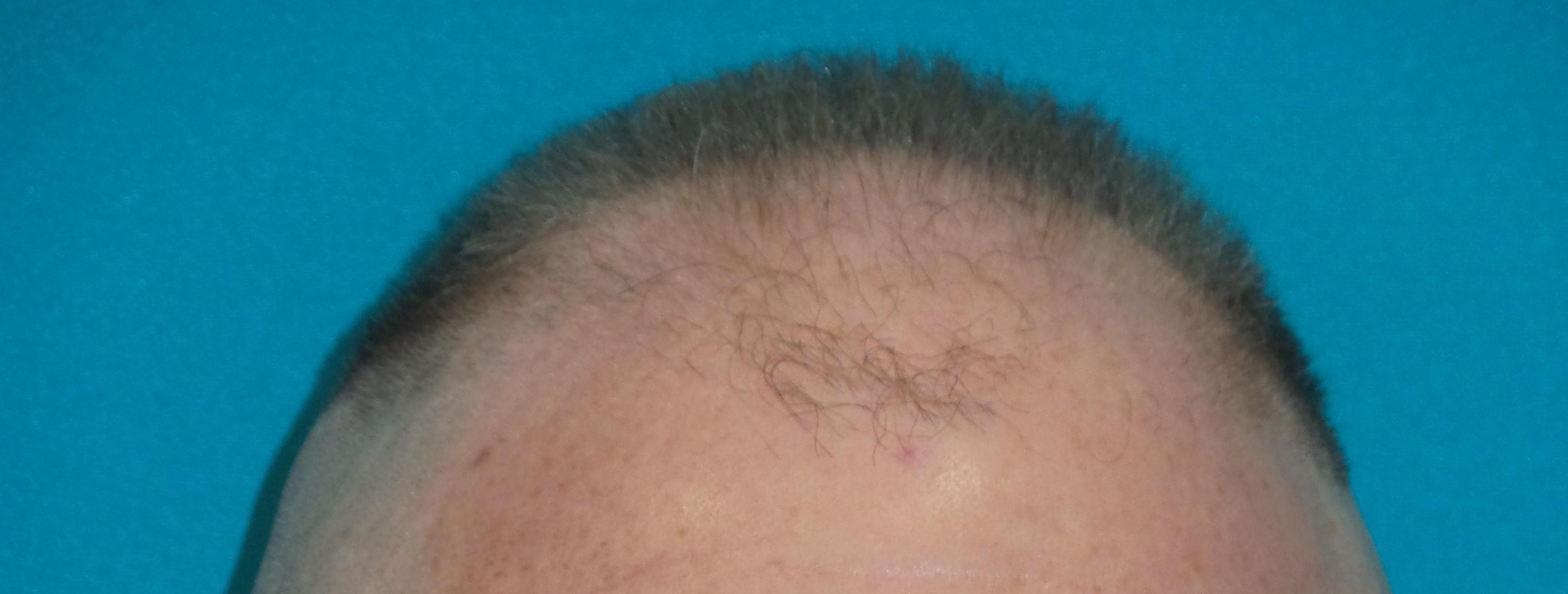 Hair Transplant Before and After | Princeton Plastic Surgeons