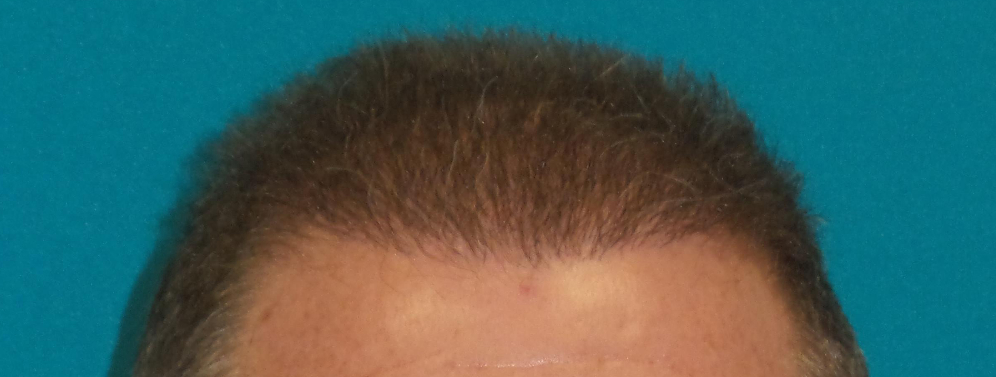 Hair Transplant Before and After | Princeton Plastic Surgeons