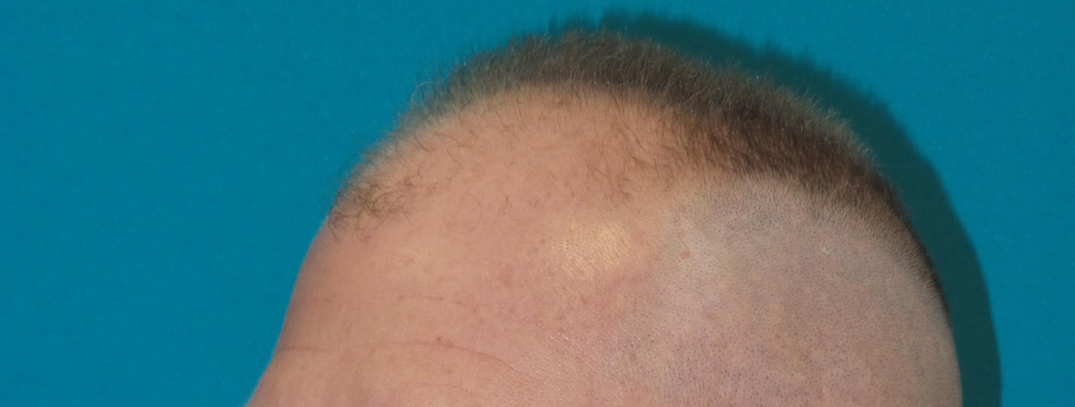 Hair Transplant Before and After | Princeton Plastic Surgeons