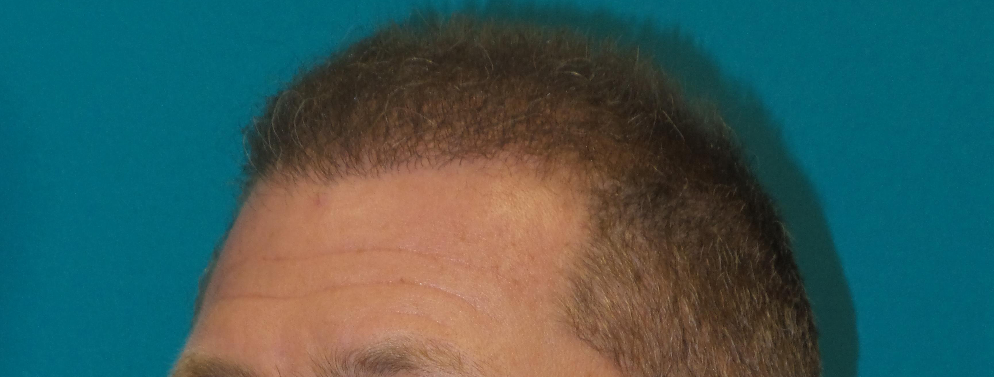 Hair Transplant Before and After | Princeton Plastic Surgeons