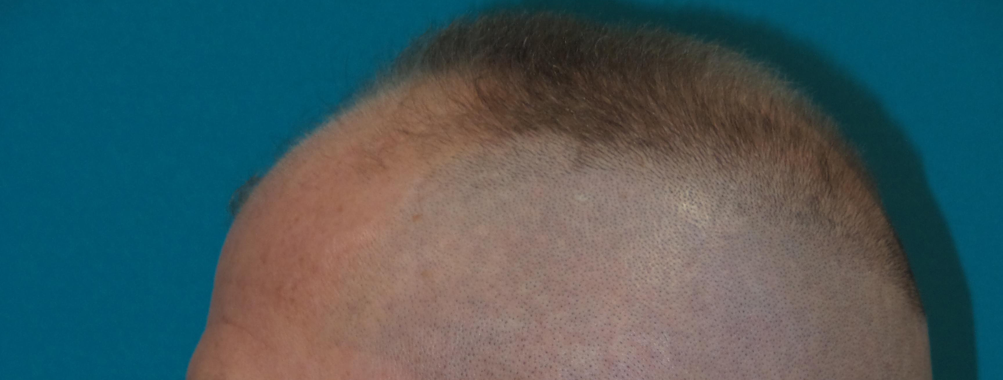 Hair Transplant Before and After | Princeton Plastic Surgeons