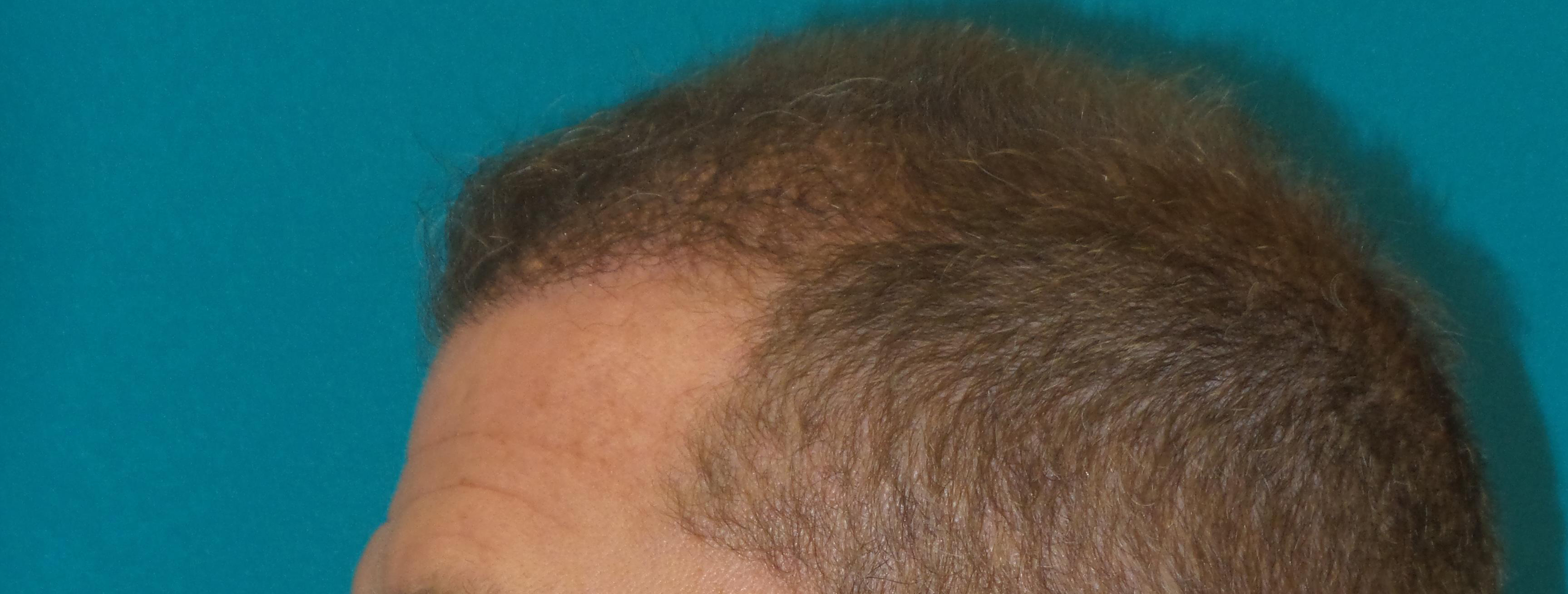 Hair Transplant Before and After | Princeton Plastic Surgeons