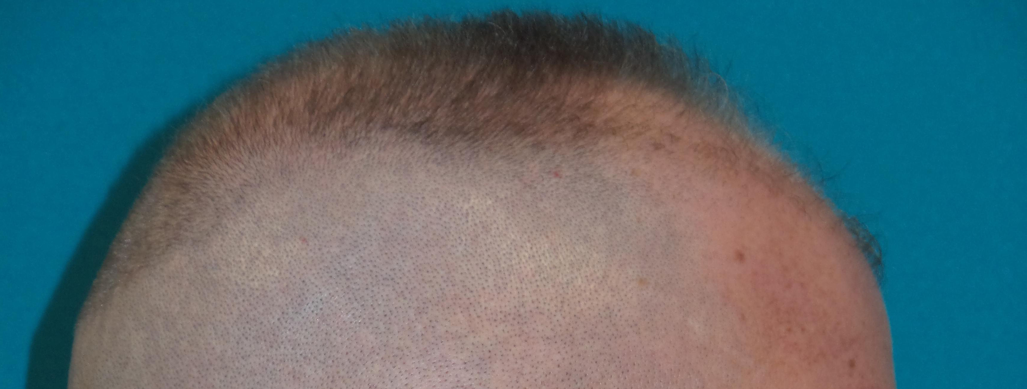 Hair Transplant Before and After | Princeton Plastic Surgeons