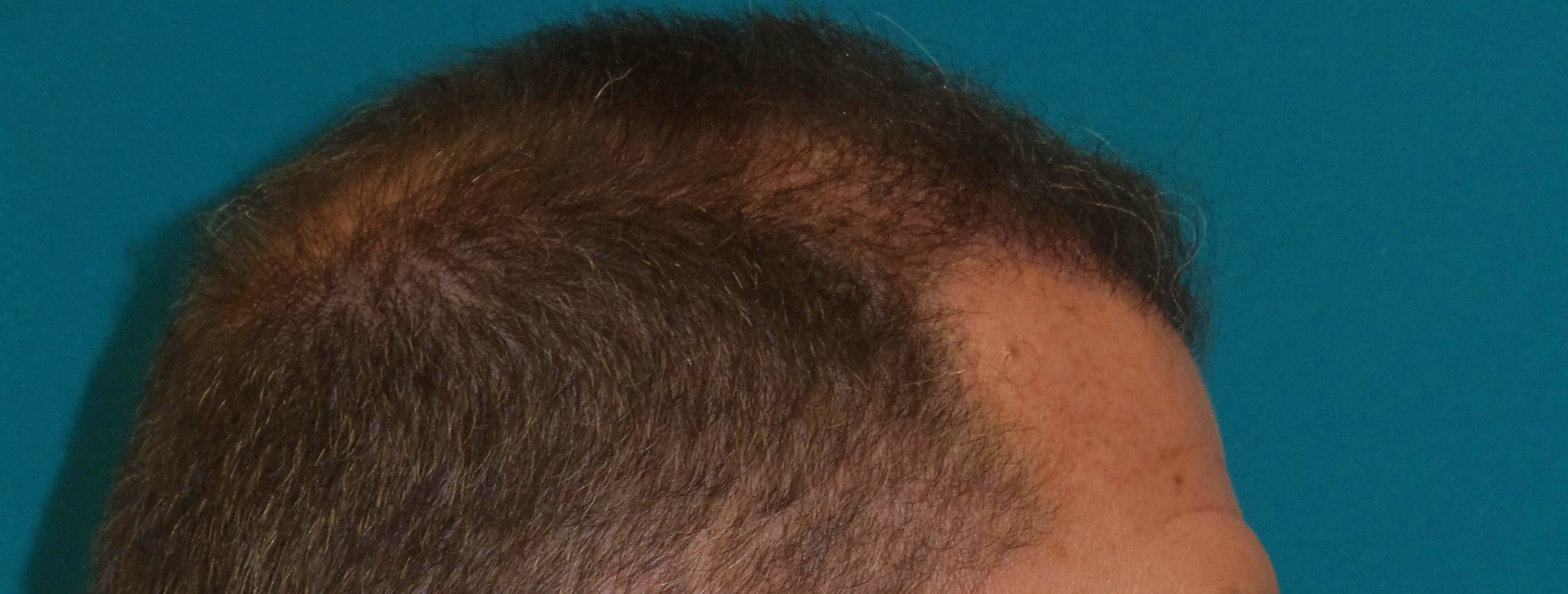 Hair Transplant Before and After | Princeton Plastic Surgeons