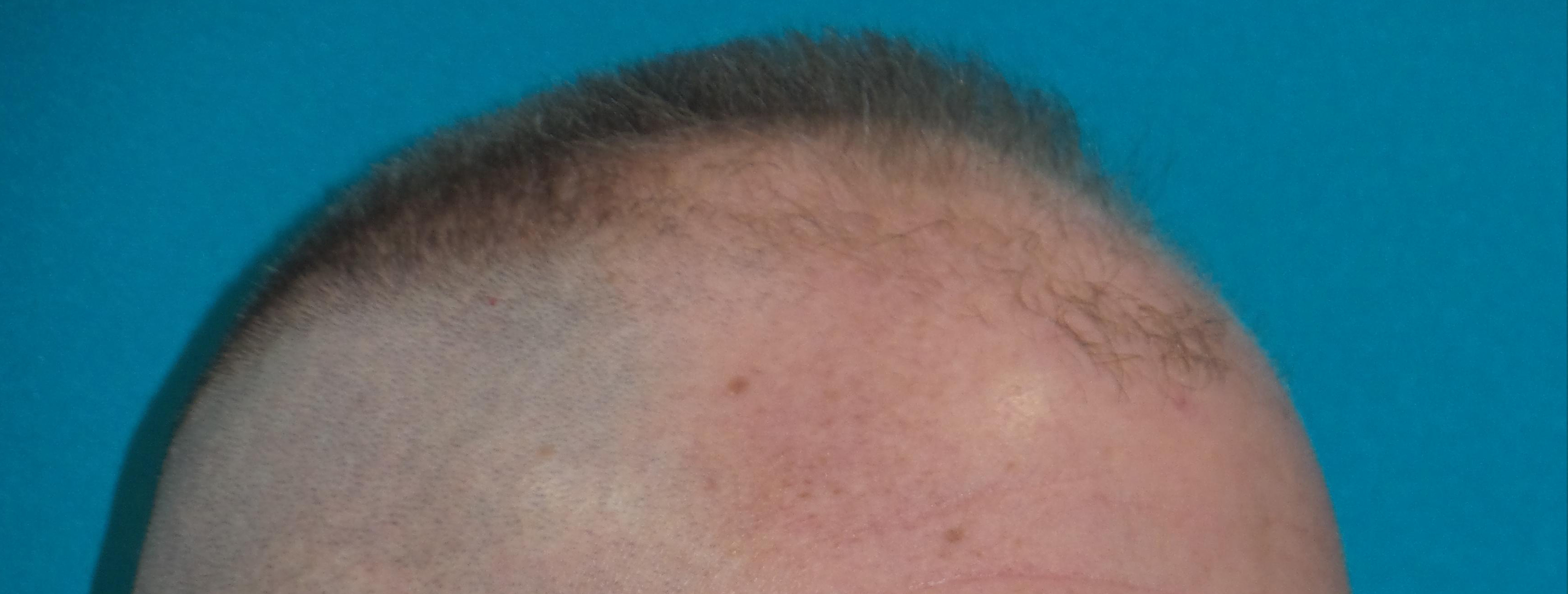 Hair Transplant Before and After | Princeton Plastic Surgeons