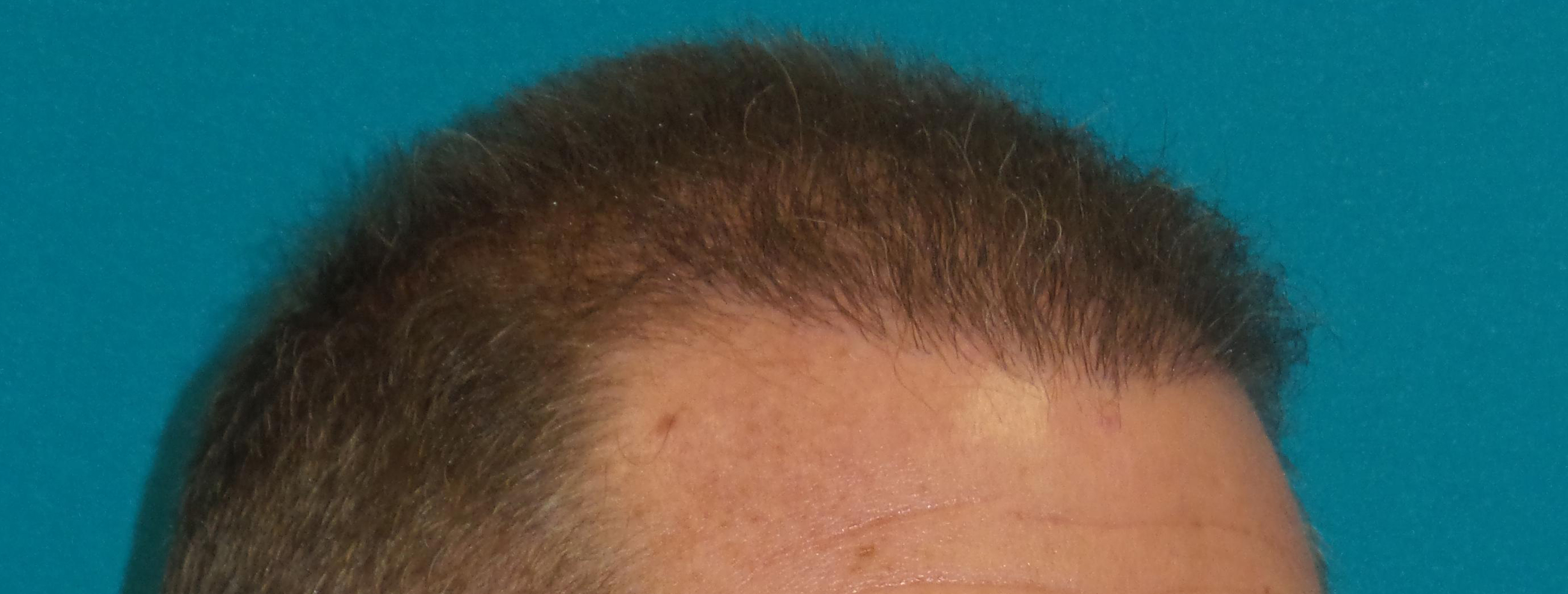 Hair Transplant Before and After | Princeton Plastic Surgeons