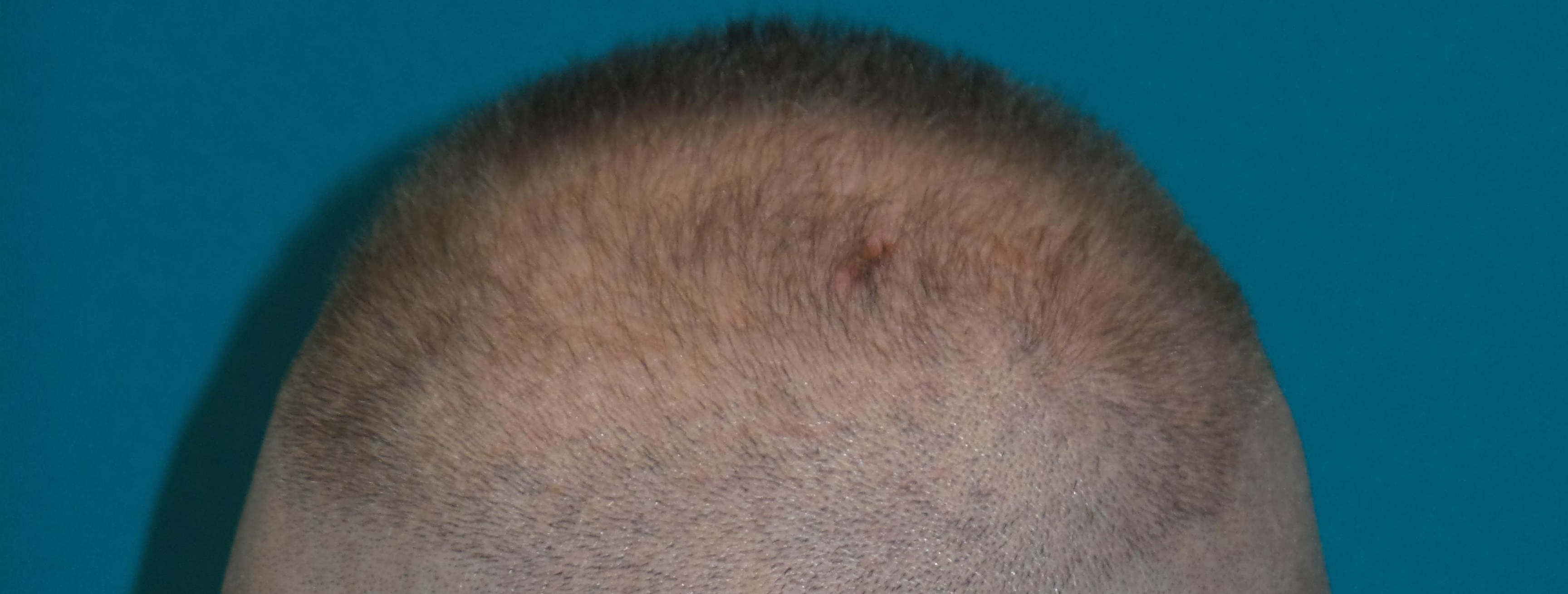 Hair Transplant Before and After | Princeton Plastic Surgeons