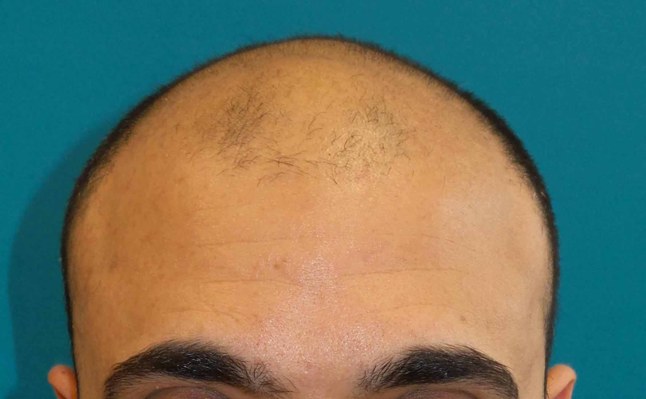 Hair Transplant Before and After | Princeton Plastic Surgeons