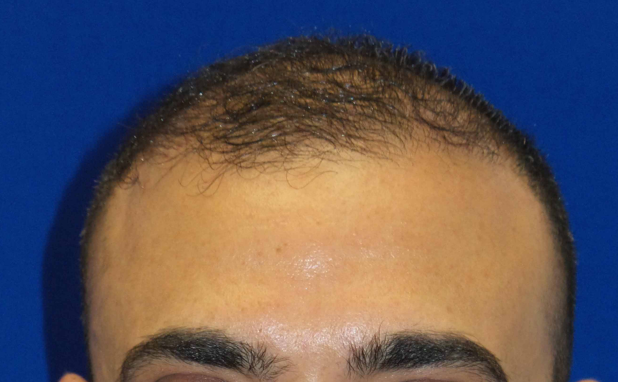 Hair Transplant Before and After | Princeton Plastic Surgeons