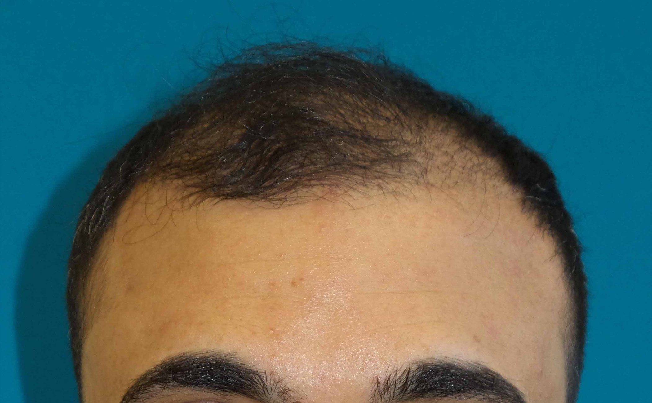 Hair Transplant Before and After | Princeton Plastic Surgeons