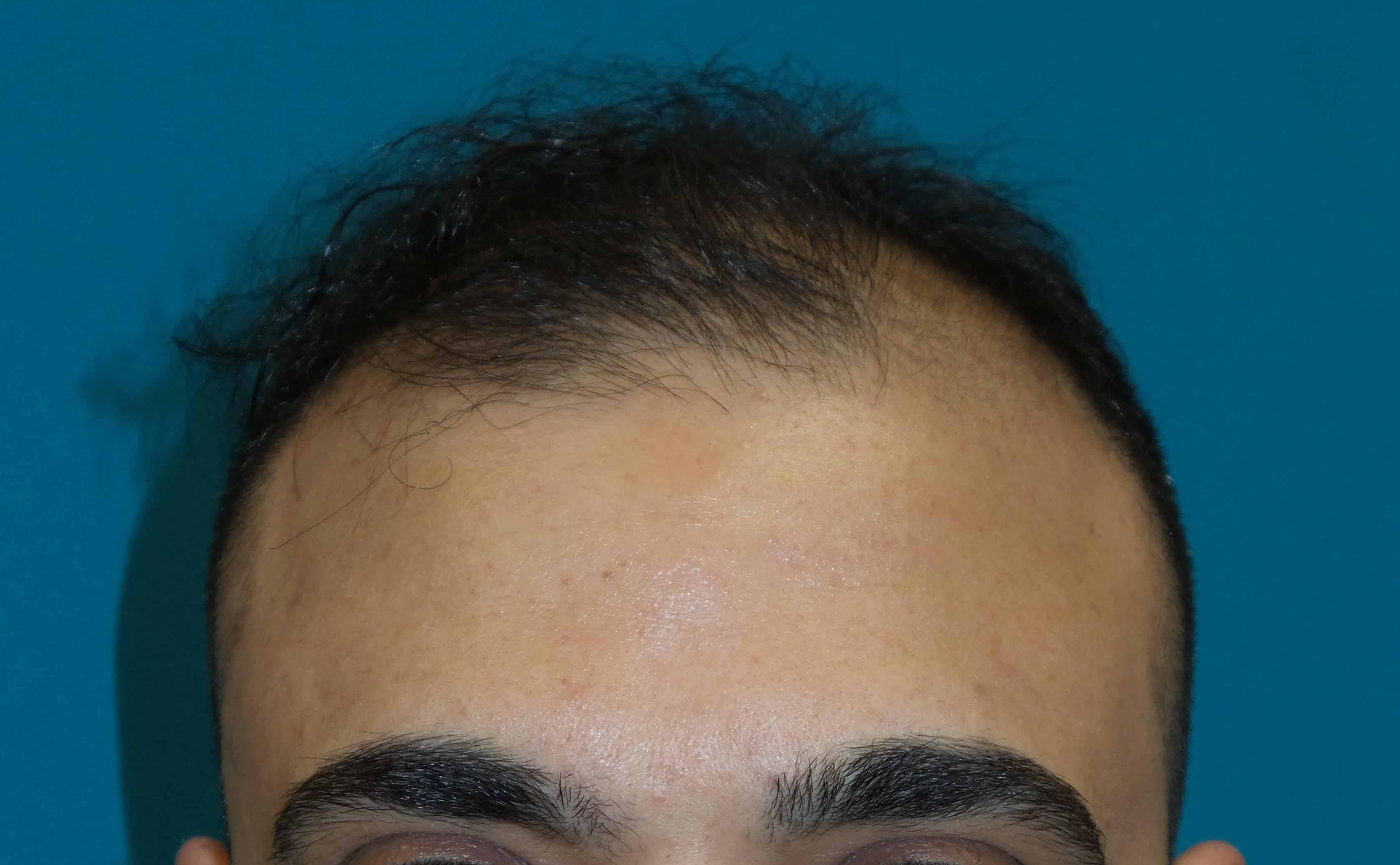 Hair Transplant Before and After | Princeton Plastic Surgeons