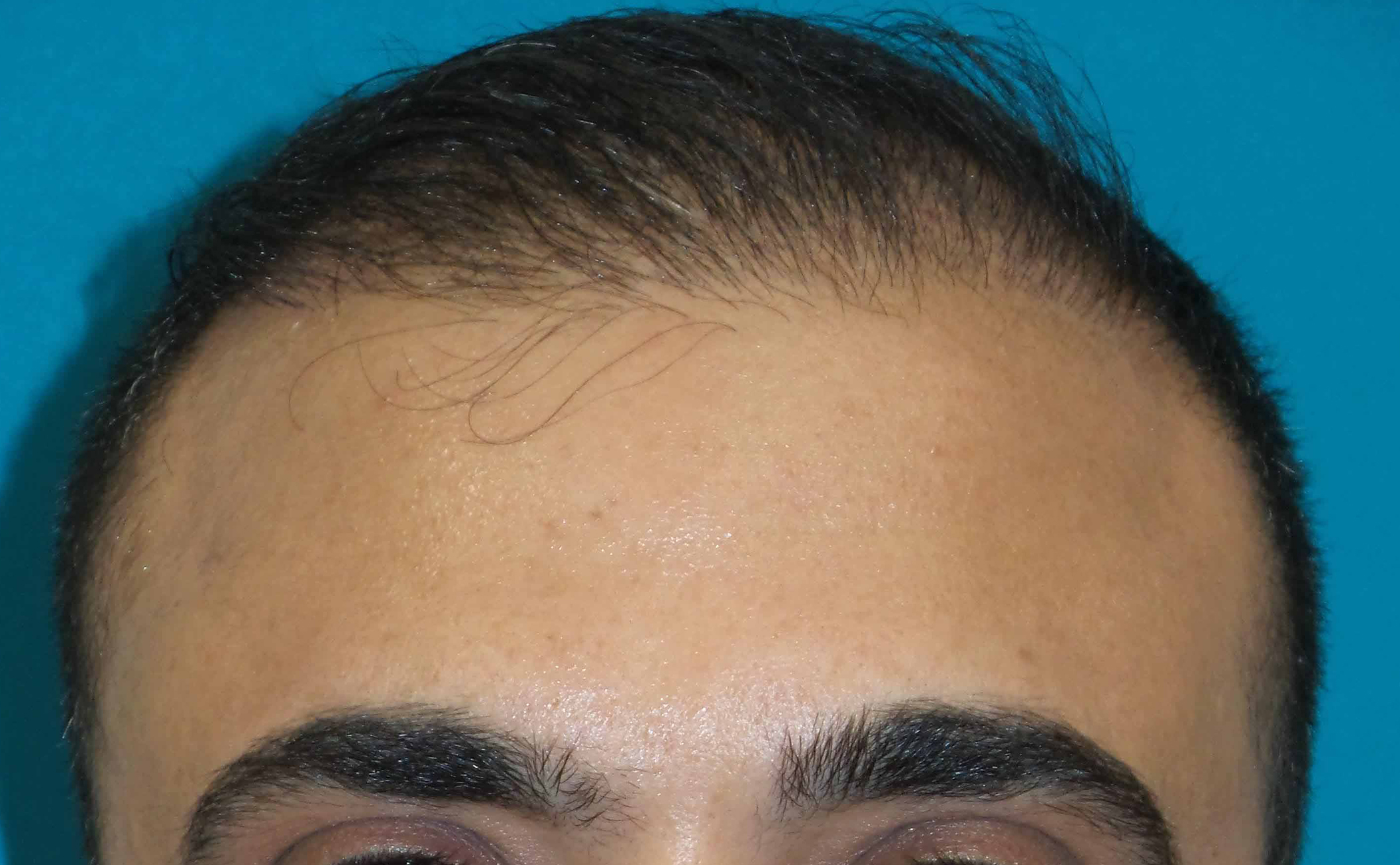 Hair Transplant Before and After | Princeton Plastic Surgeons