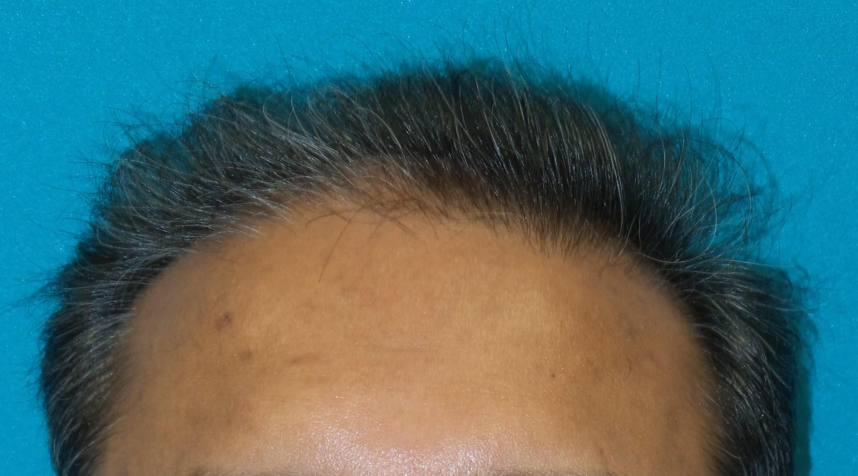 Hair Transplant Before and After | Princeton Plastic Surgeons