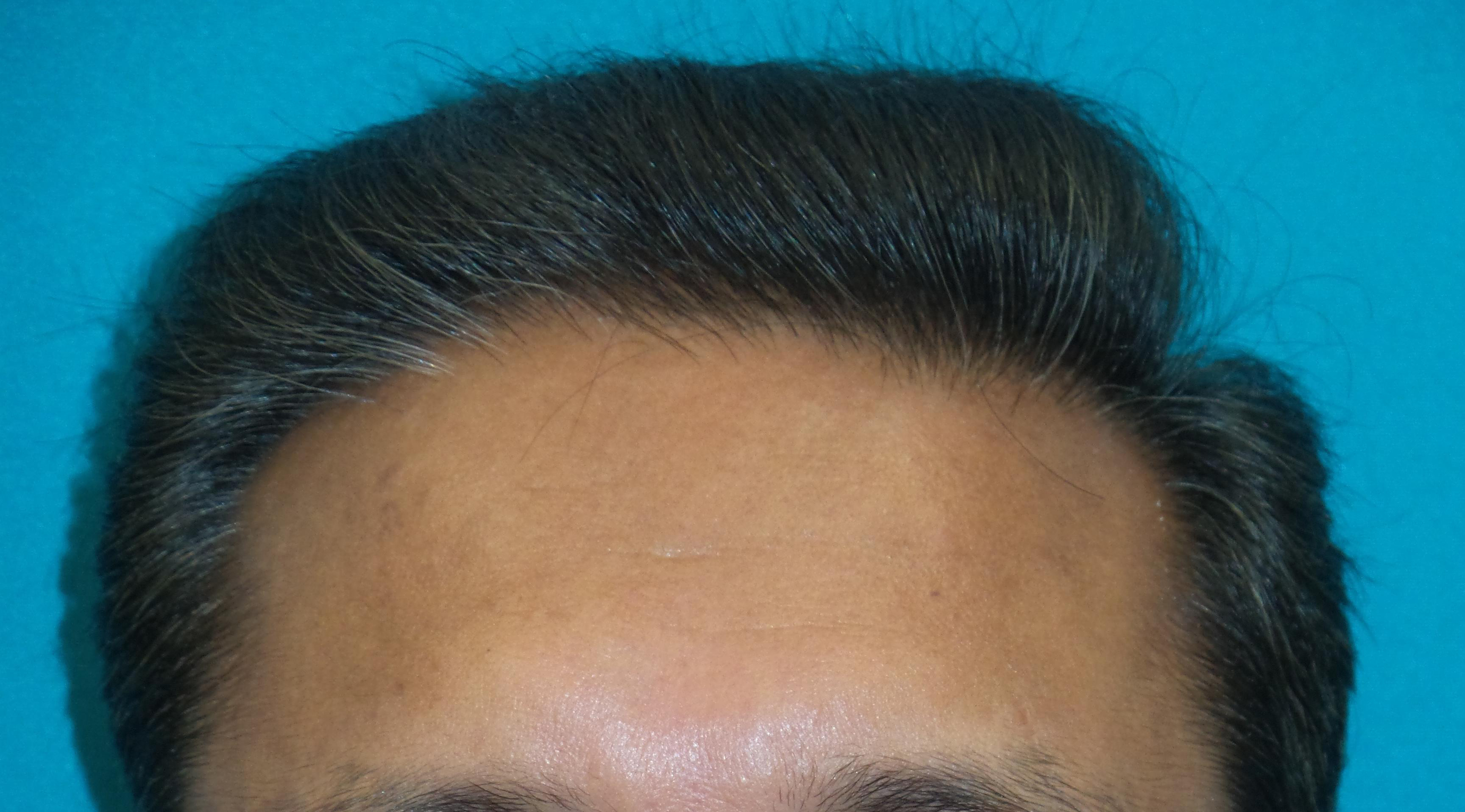 Hair Transplant Before and After | Princeton Plastic Surgeons