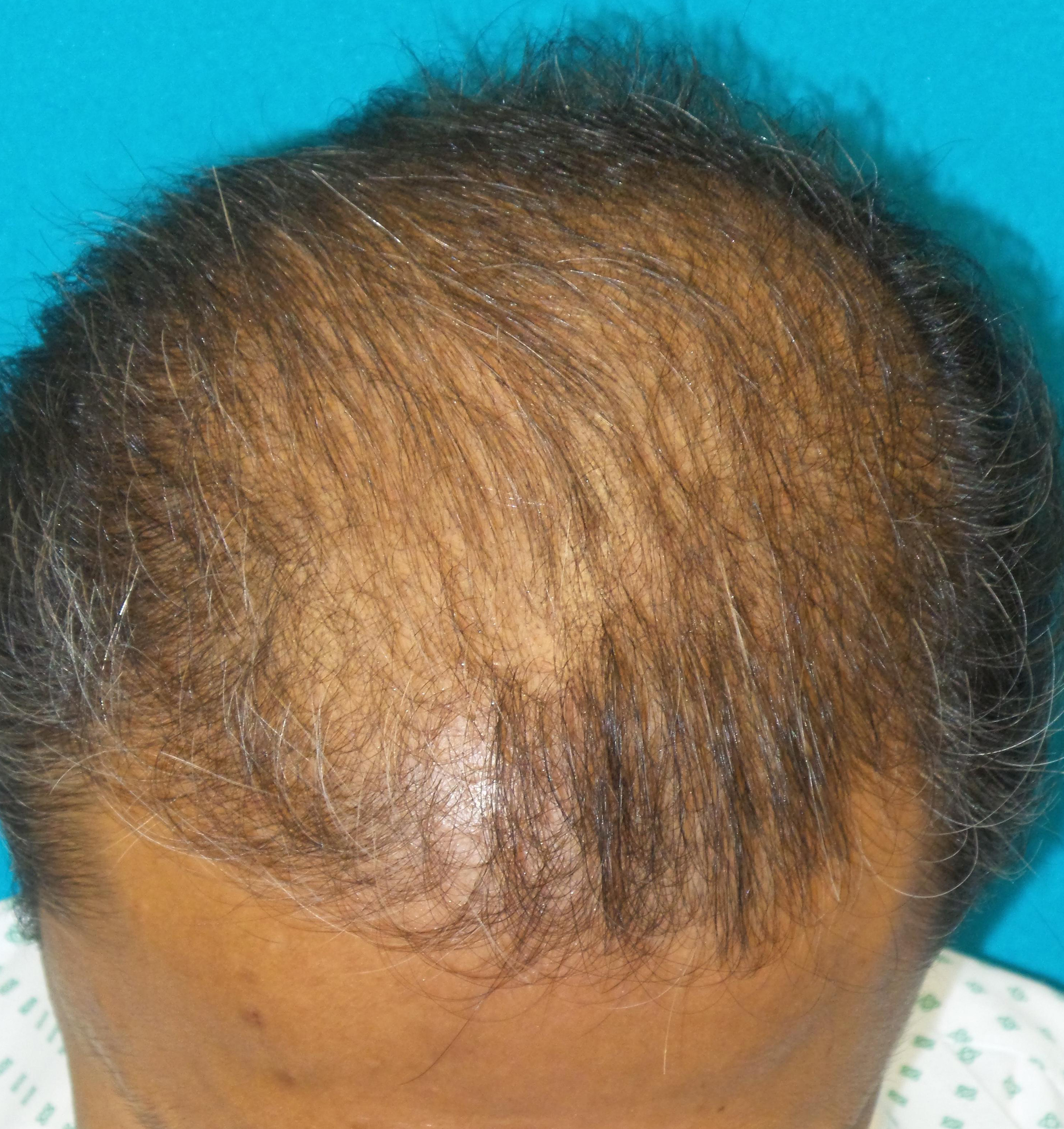 Hair Transplant Before and After | Princeton Plastic Surgeons