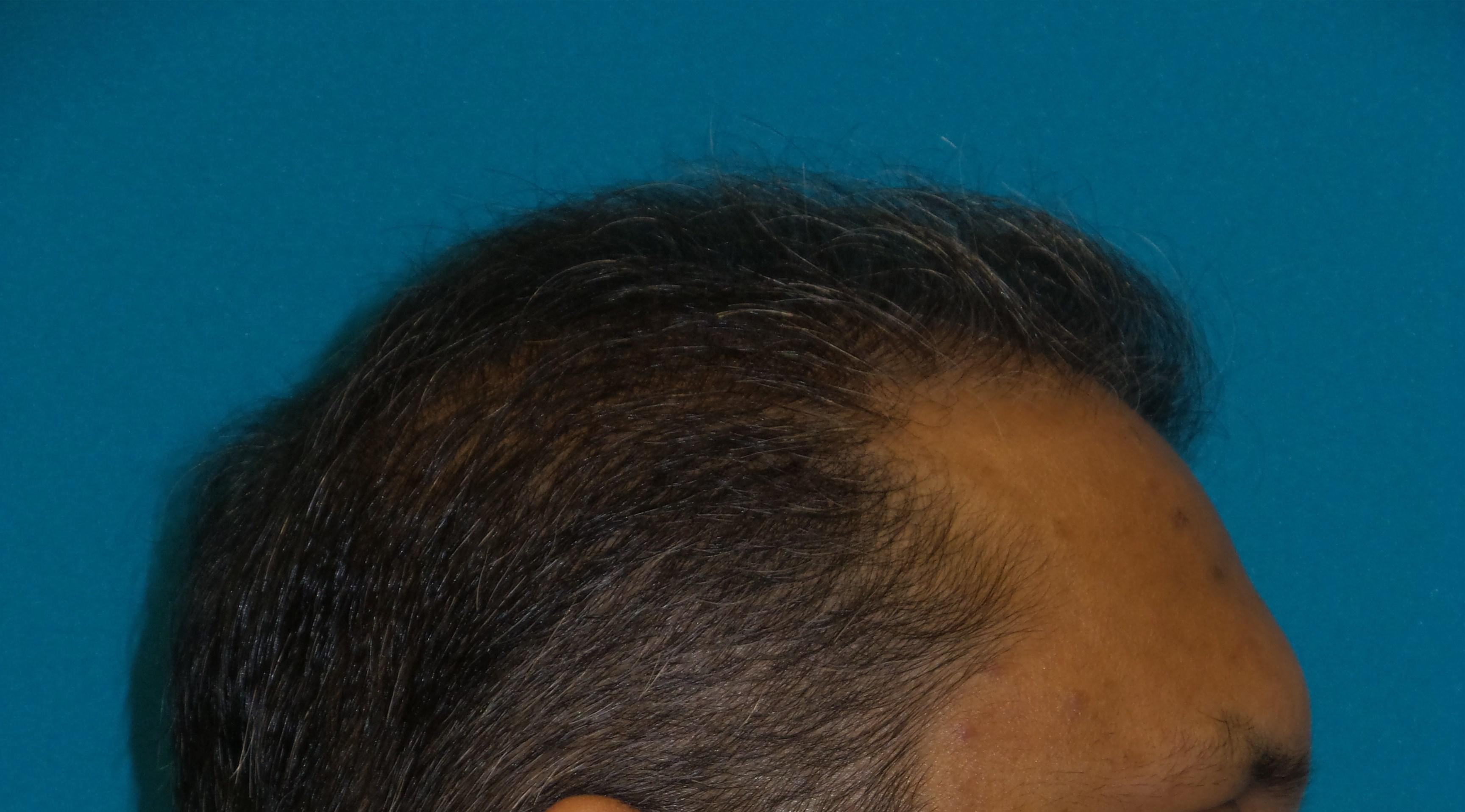 Hair Transplant Before and After | Princeton Plastic Surgeons