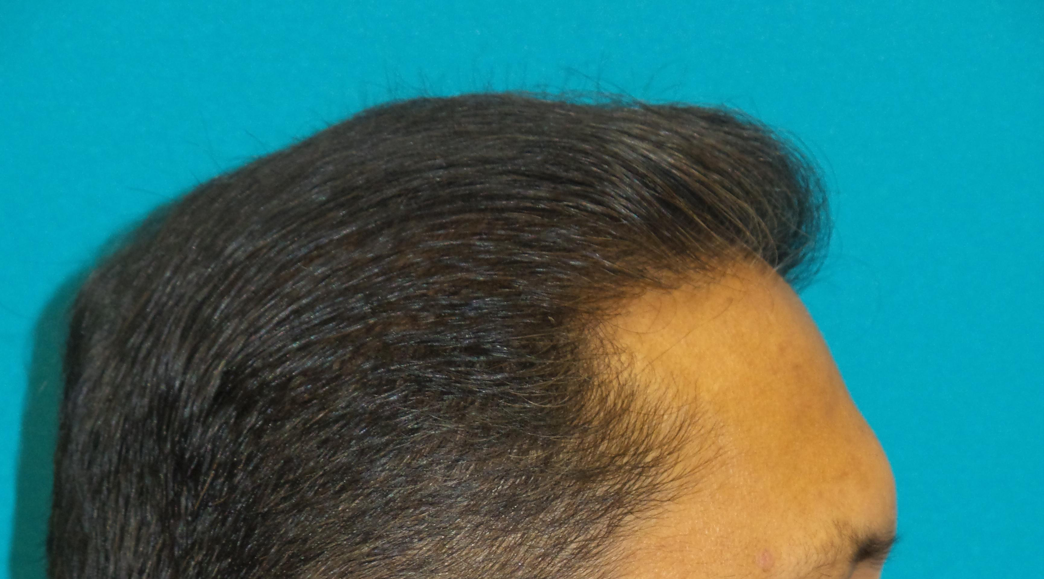 Hair Transplant Before and After | Princeton Plastic Surgeons