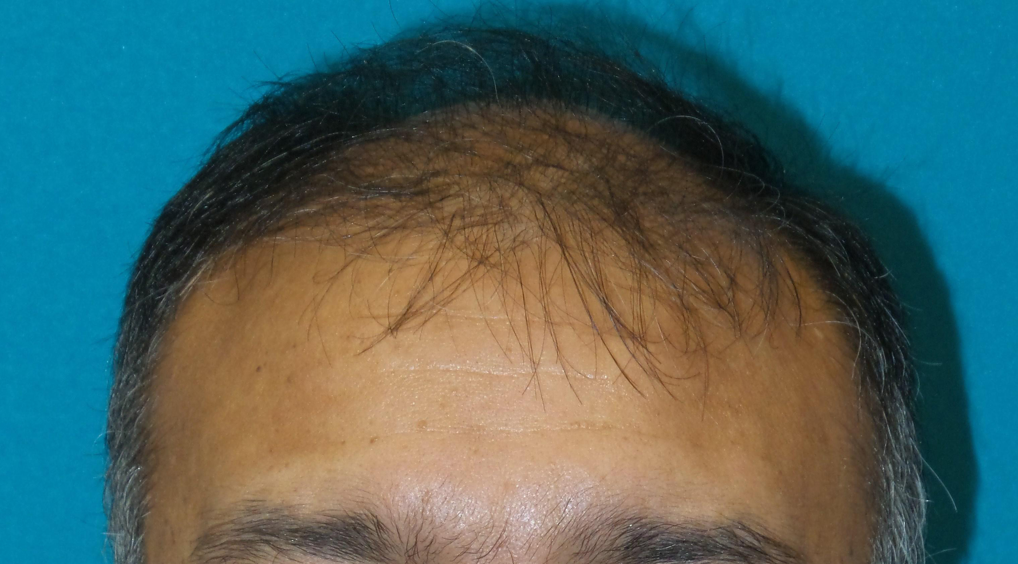 Hair Transplant Before and After | Princeton Plastic Surgeons