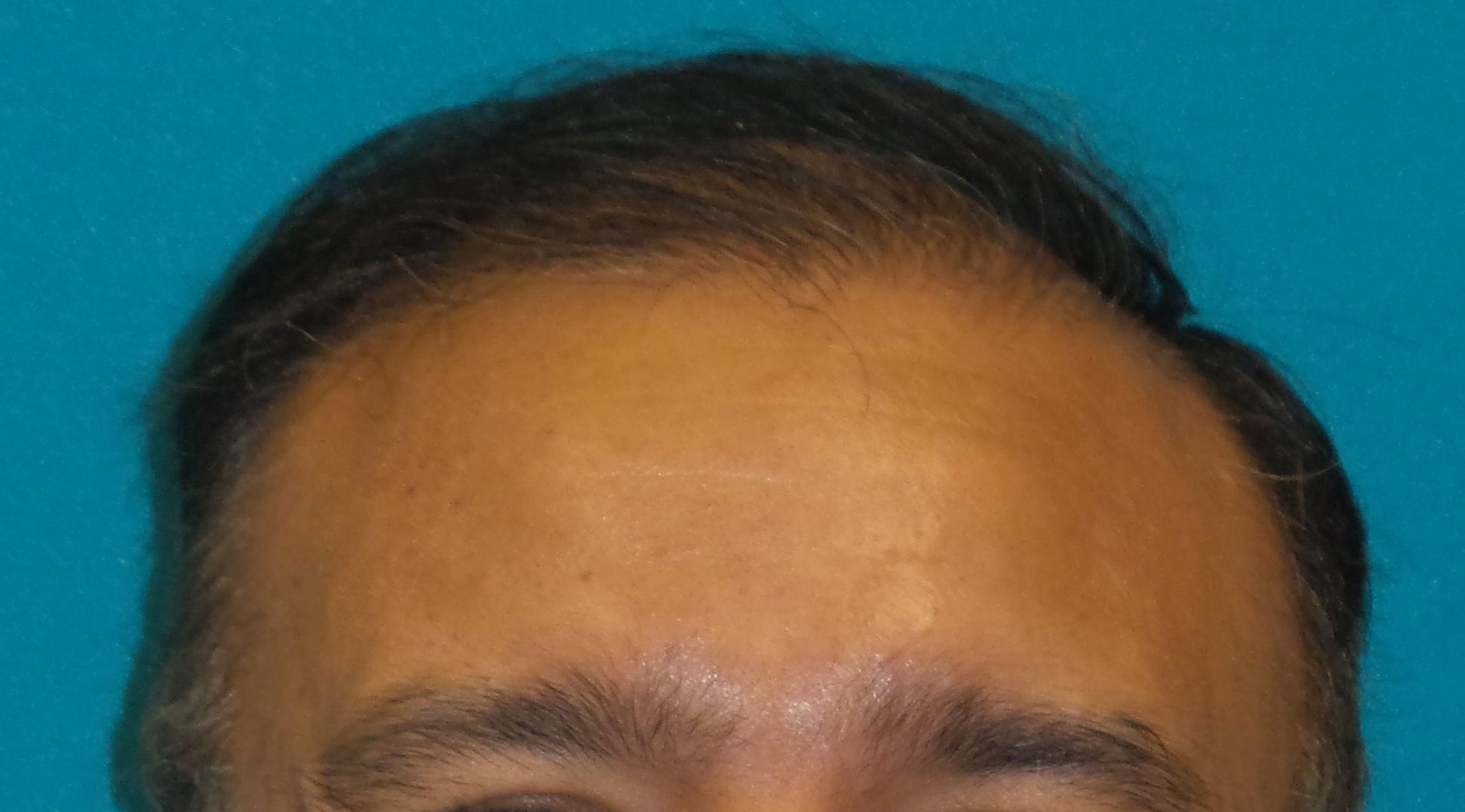 Hair Transplant Before and After | Princeton Plastic Surgeons