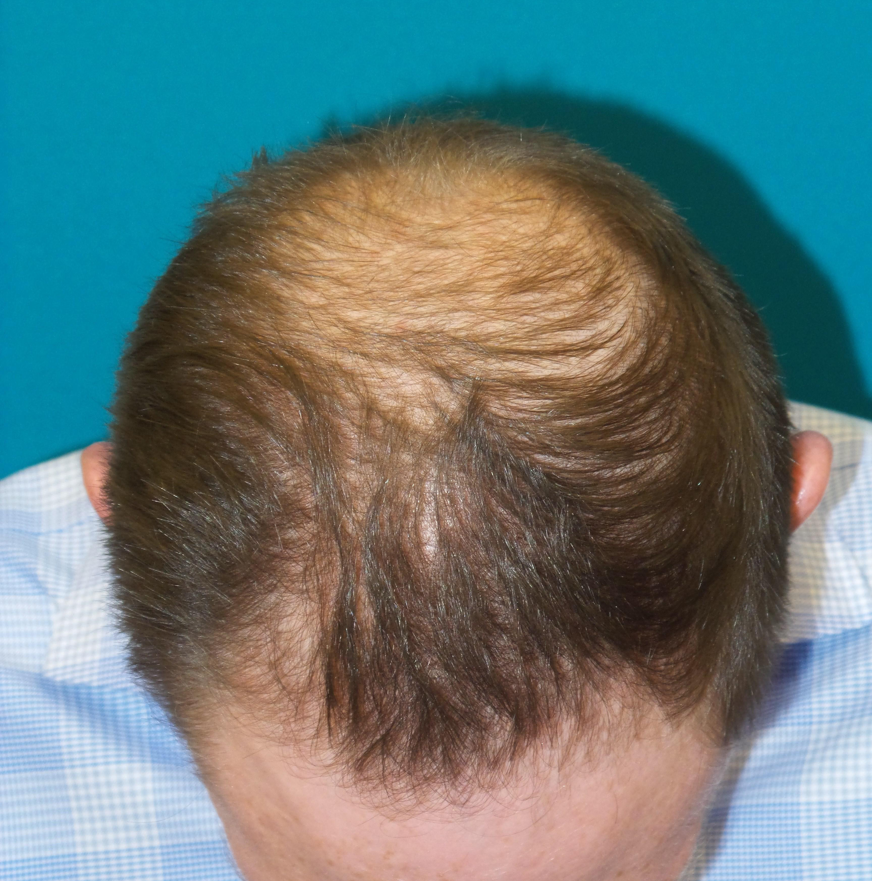 Hair Transplant Before and After | Princeton Plastic Surgeons