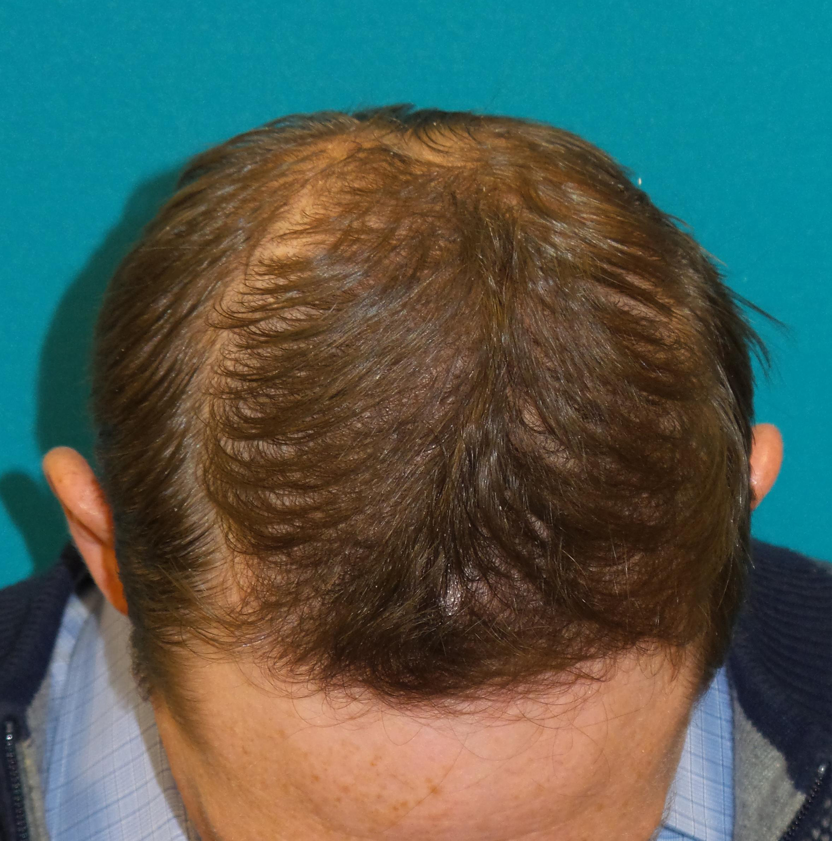 Hair Transplant Before and After | Princeton Plastic Surgeons