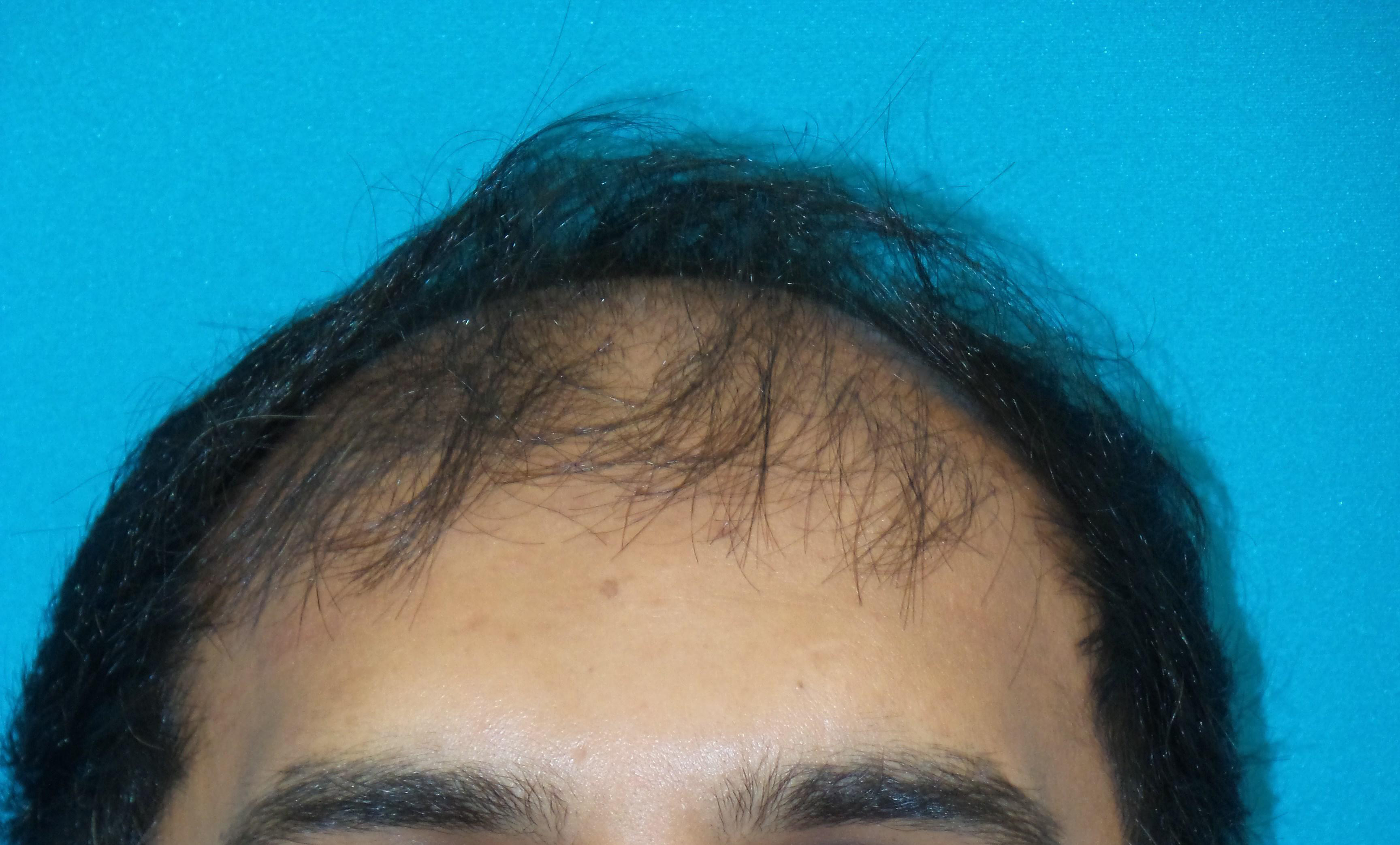 Hair Transplant Before and After | Princeton Plastic Surgeons