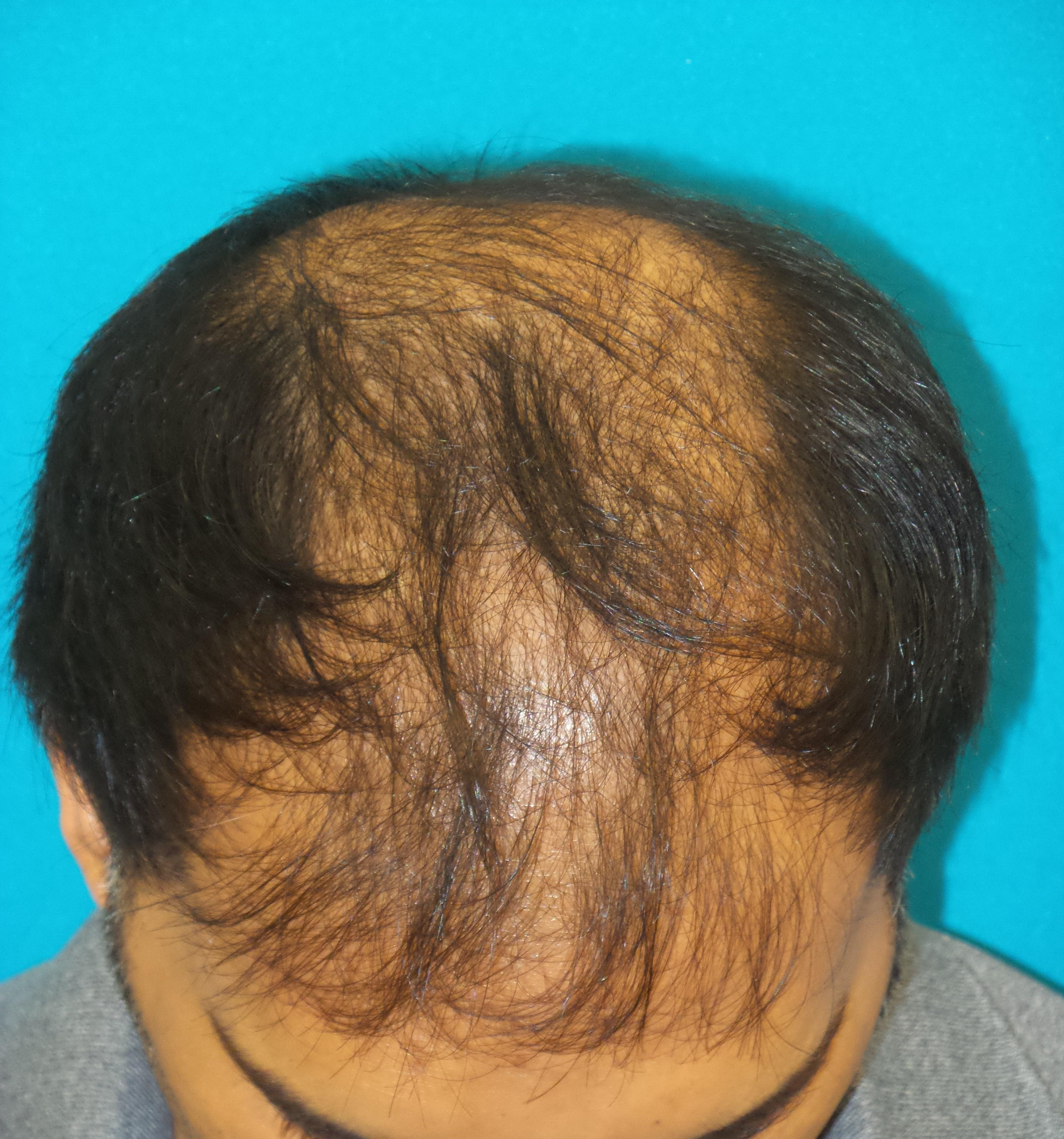 Hair Transplant Before and After | Princeton Plastic Surgeons