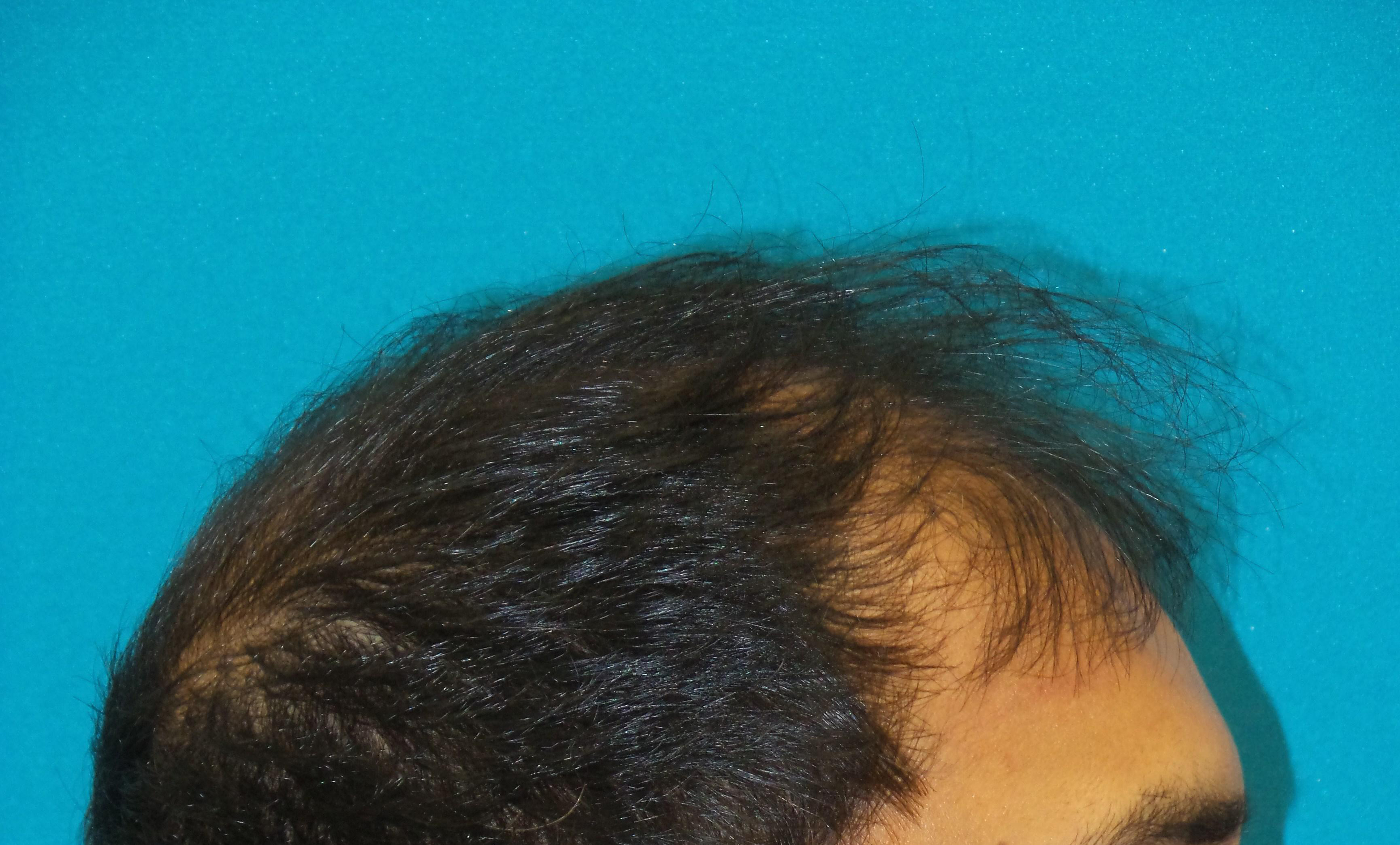 Hair Transplant Before and After | Princeton Plastic Surgeons