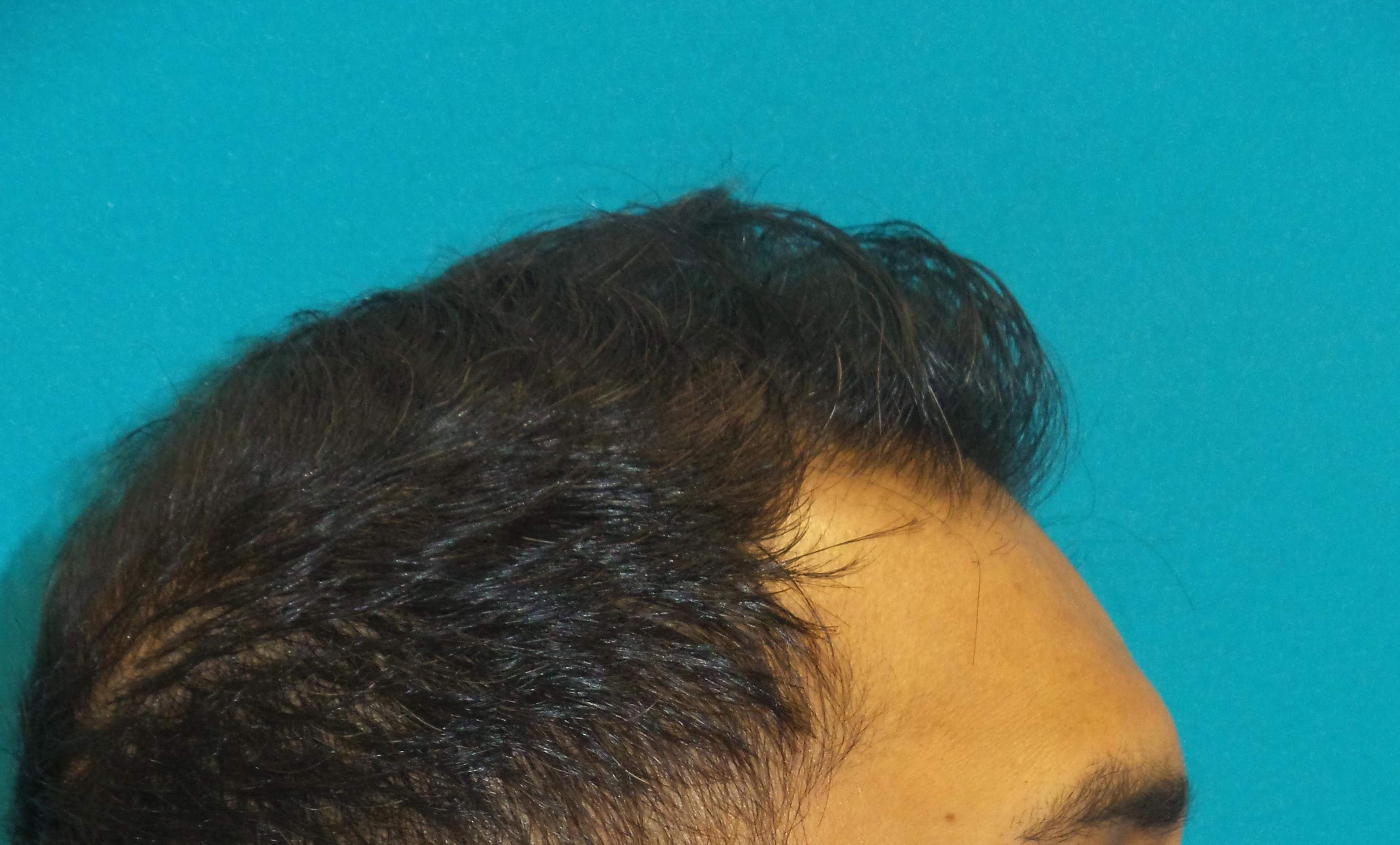 Hair Transplant Before and After | Princeton Plastic Surgeons