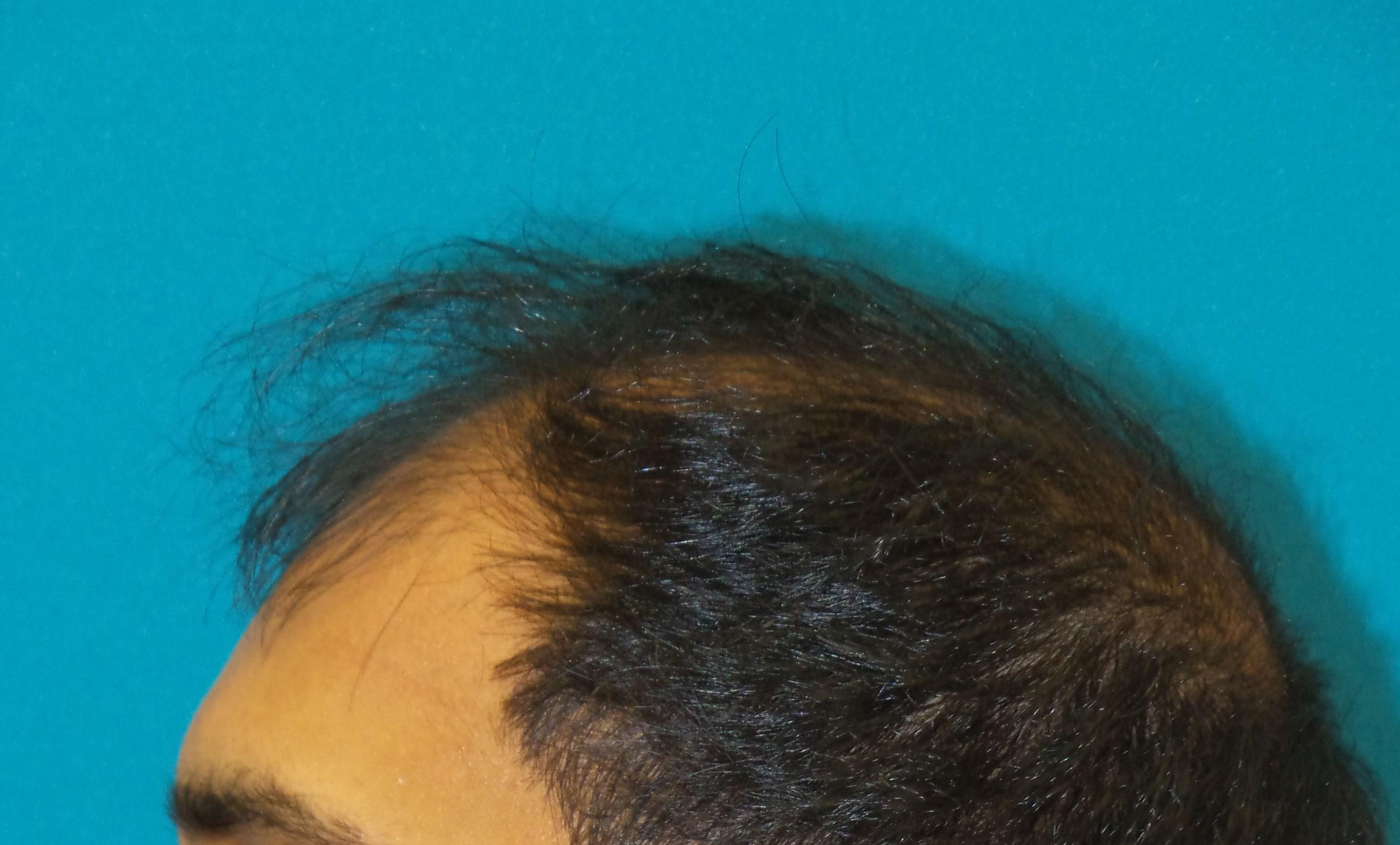 Hair Transplant Before and After | Princeton Plastic Surgeons