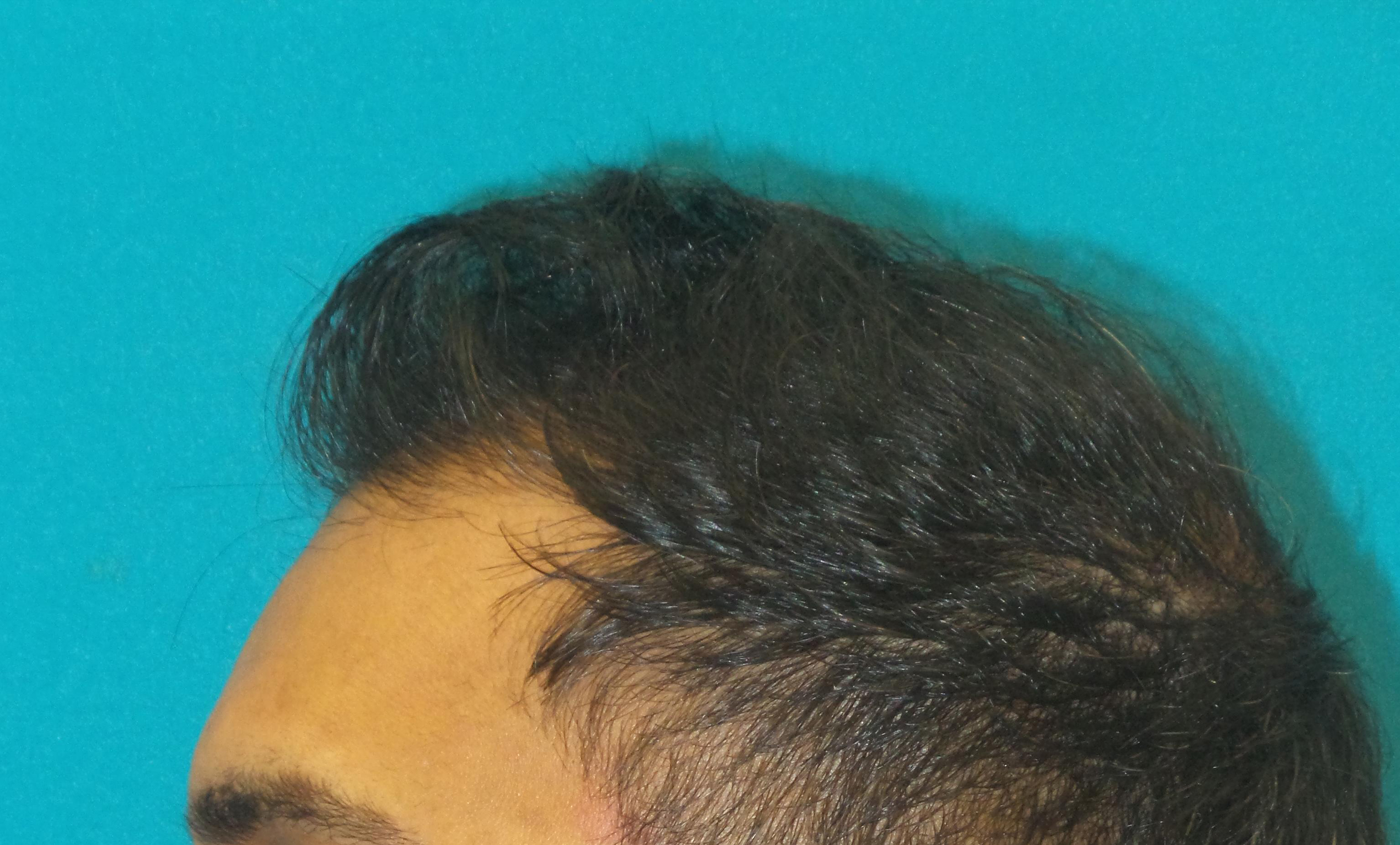 Hair Transplant Before and After | Princeton Plastic Surgeons