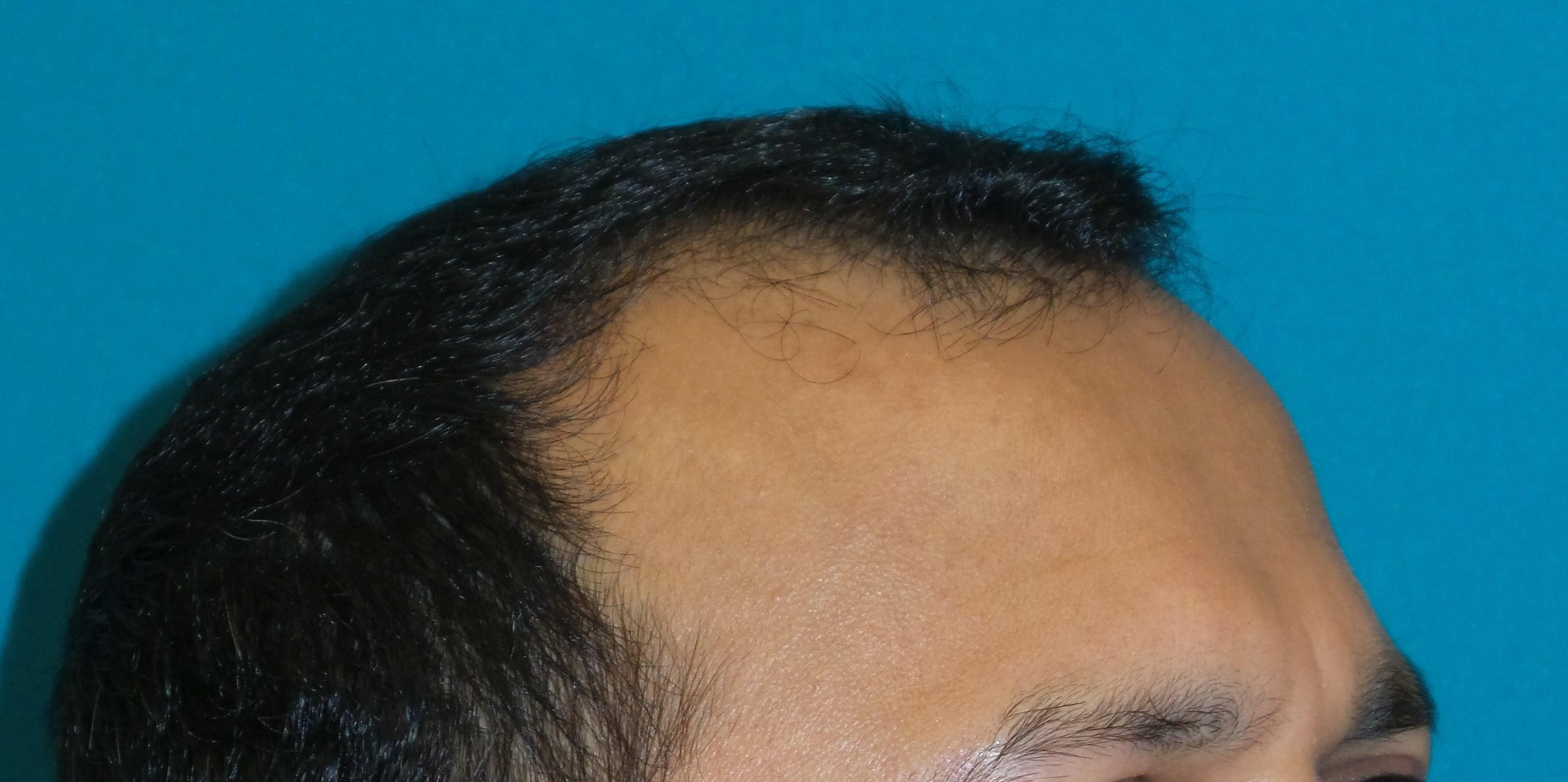 Hair Transplant Before and After | Princeton Plastic Surgeons