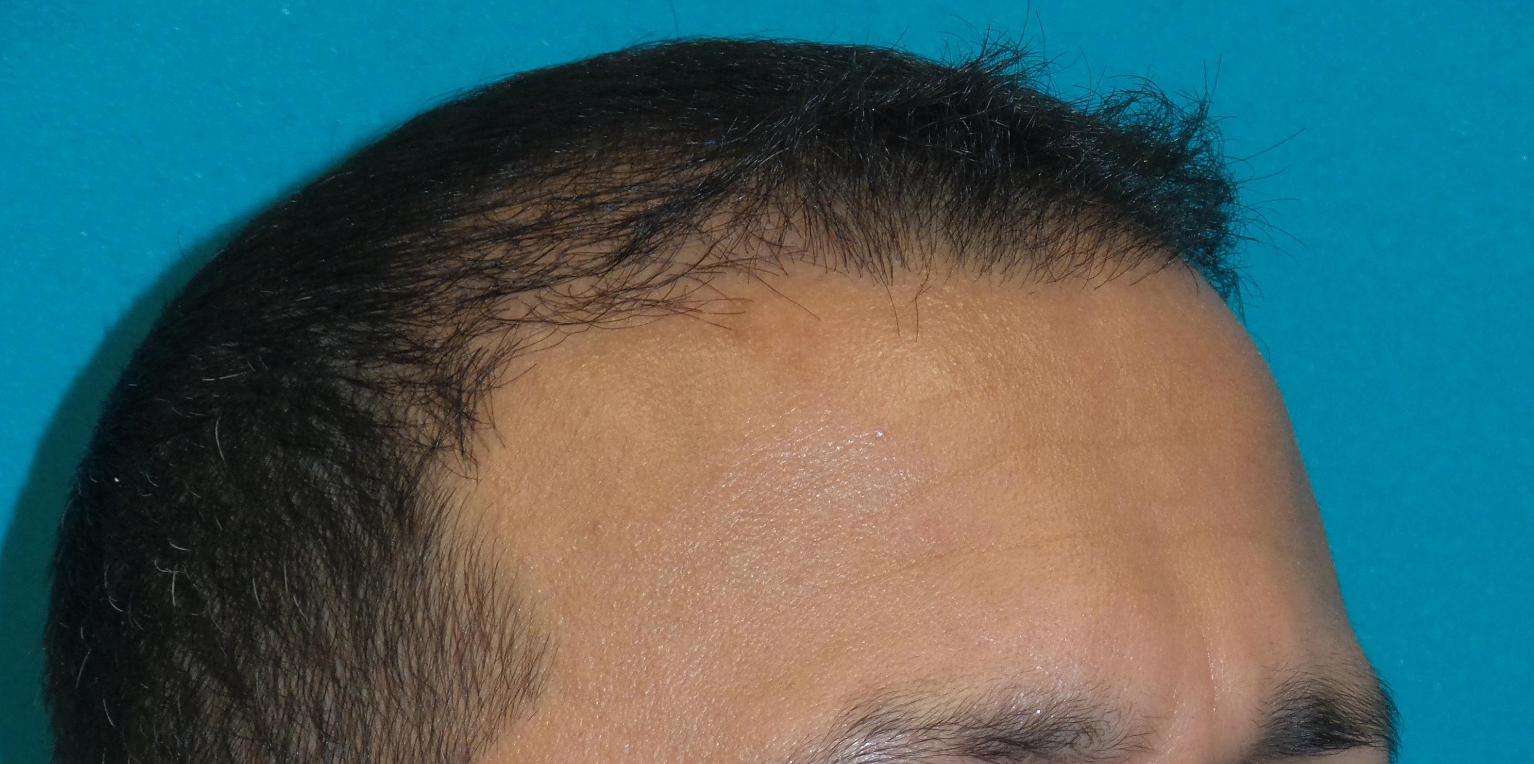 Hair Transplant Before and After | Princeton Plastic Surgeons