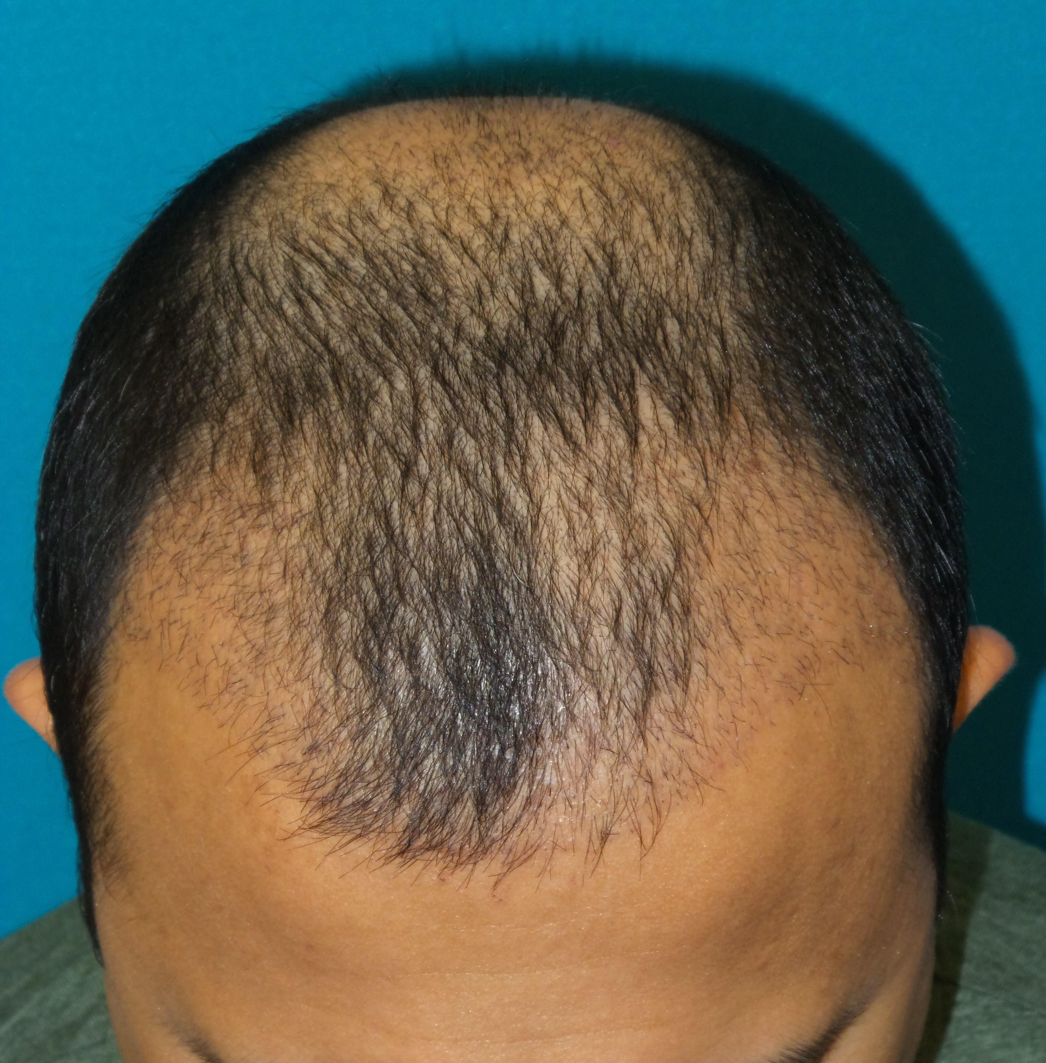 Hair Transplant Before and After | Princeton Plastic Surgeons