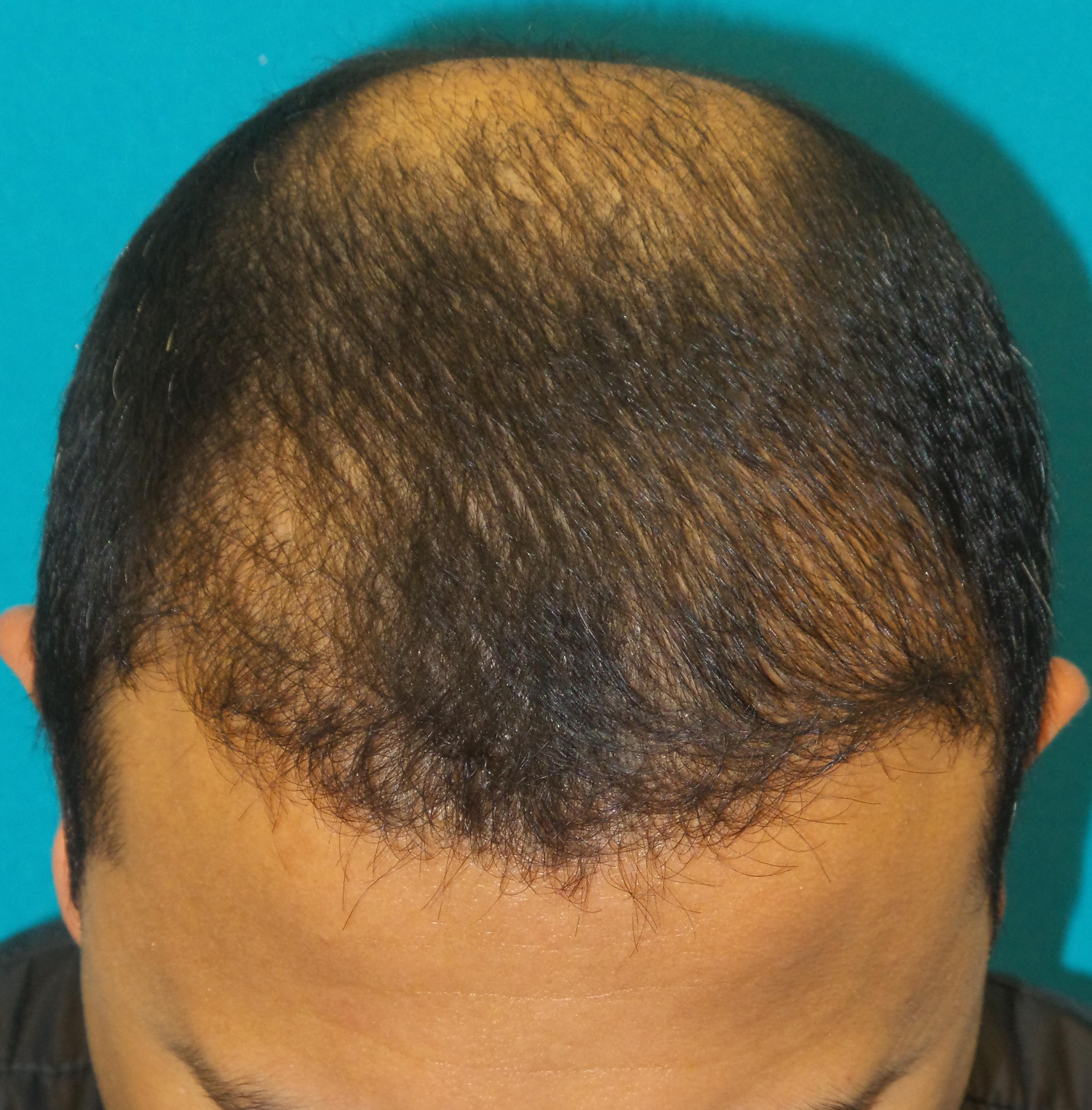 Hair Transplant Before and After | Princeton Plastic Surgeons